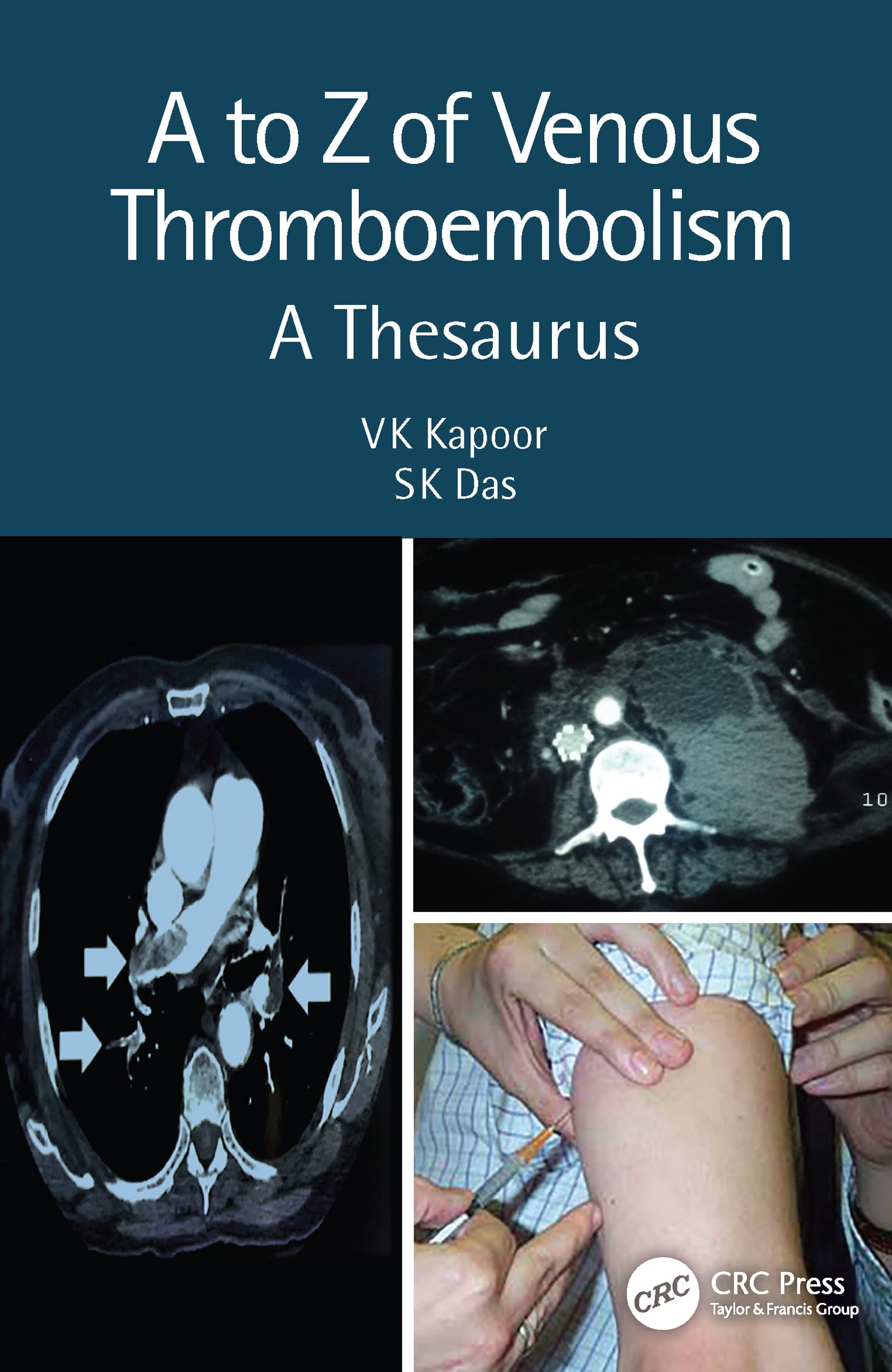 A to Z of Venous Thromboembolism: A Thesaurus Medicine
