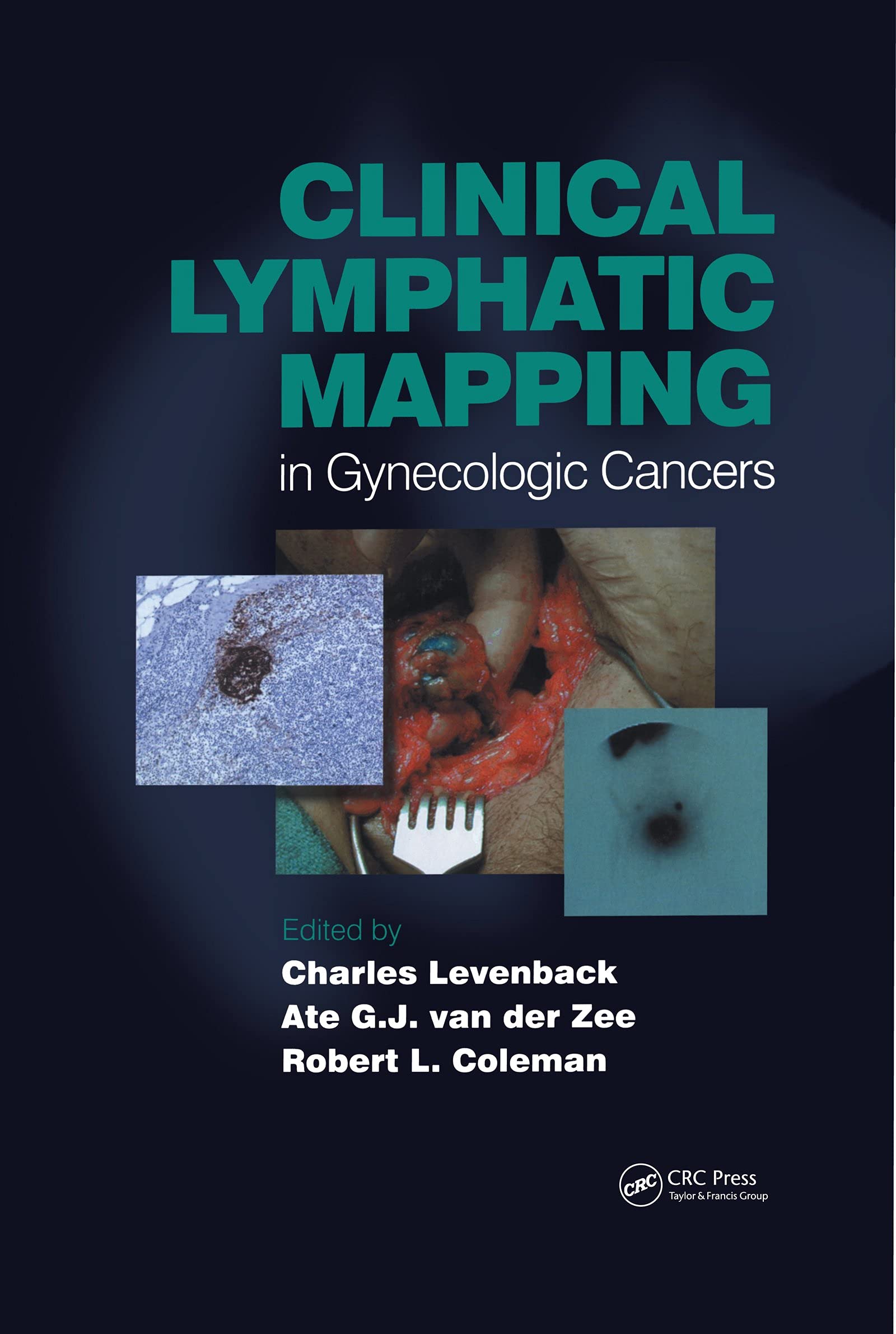 Clinical Lymphatic Mapping of Gynecologic Cancer Medicine