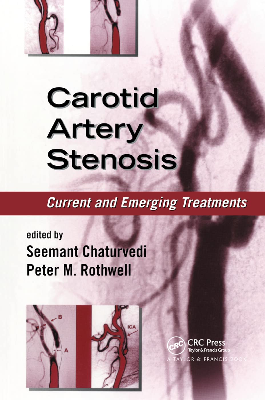 Carotid Artery Stenosis Medicine