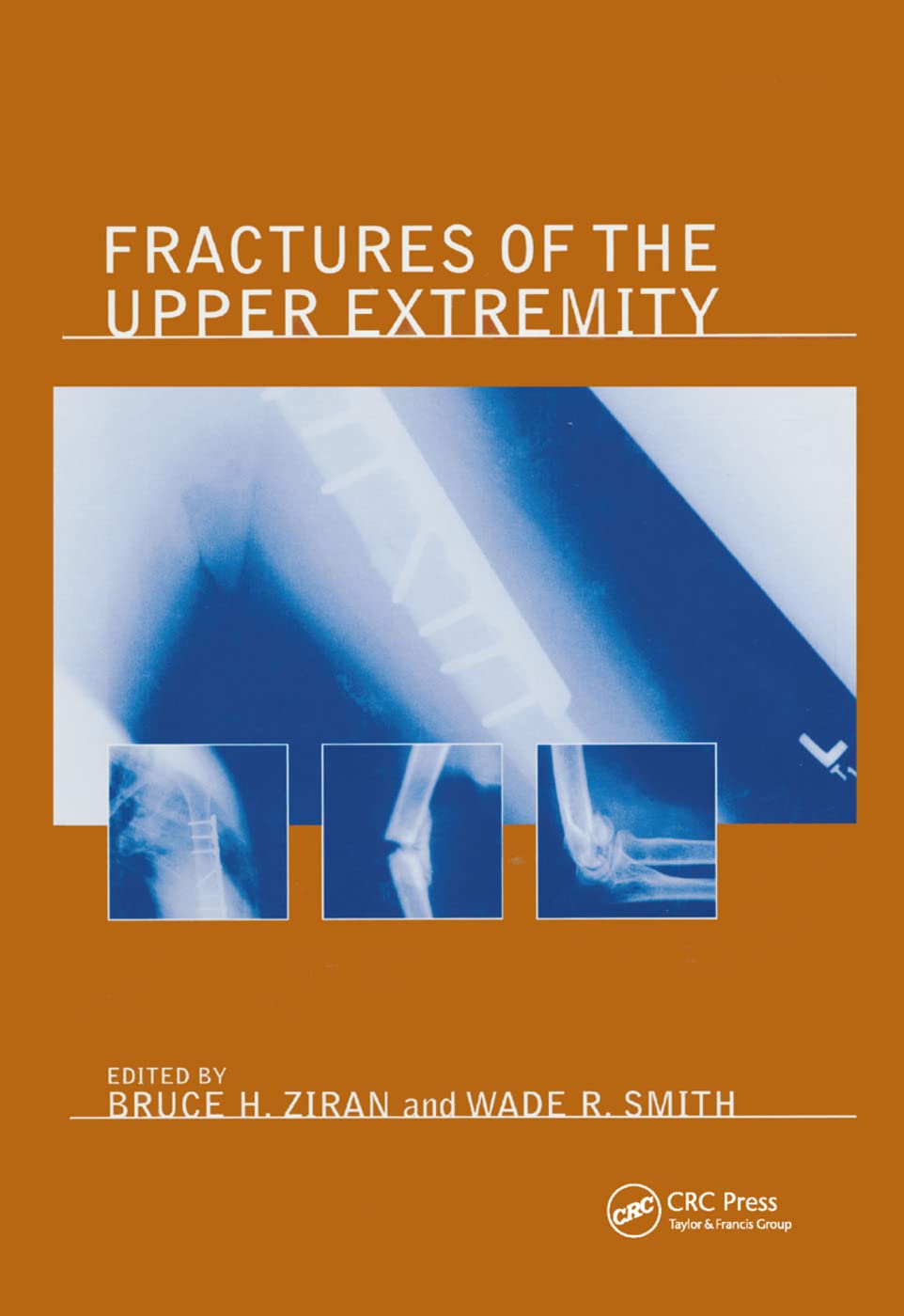 Fractures of the Upper Extremity Medicine