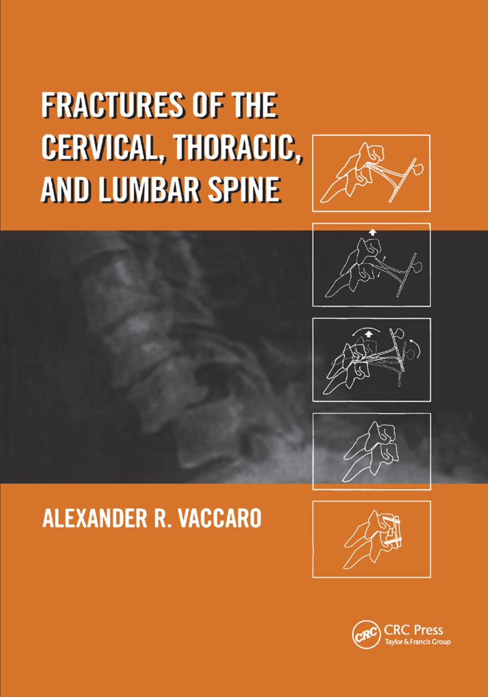 Fractures of the Cervical, Thoracic, and Lumbar Spine Medicine