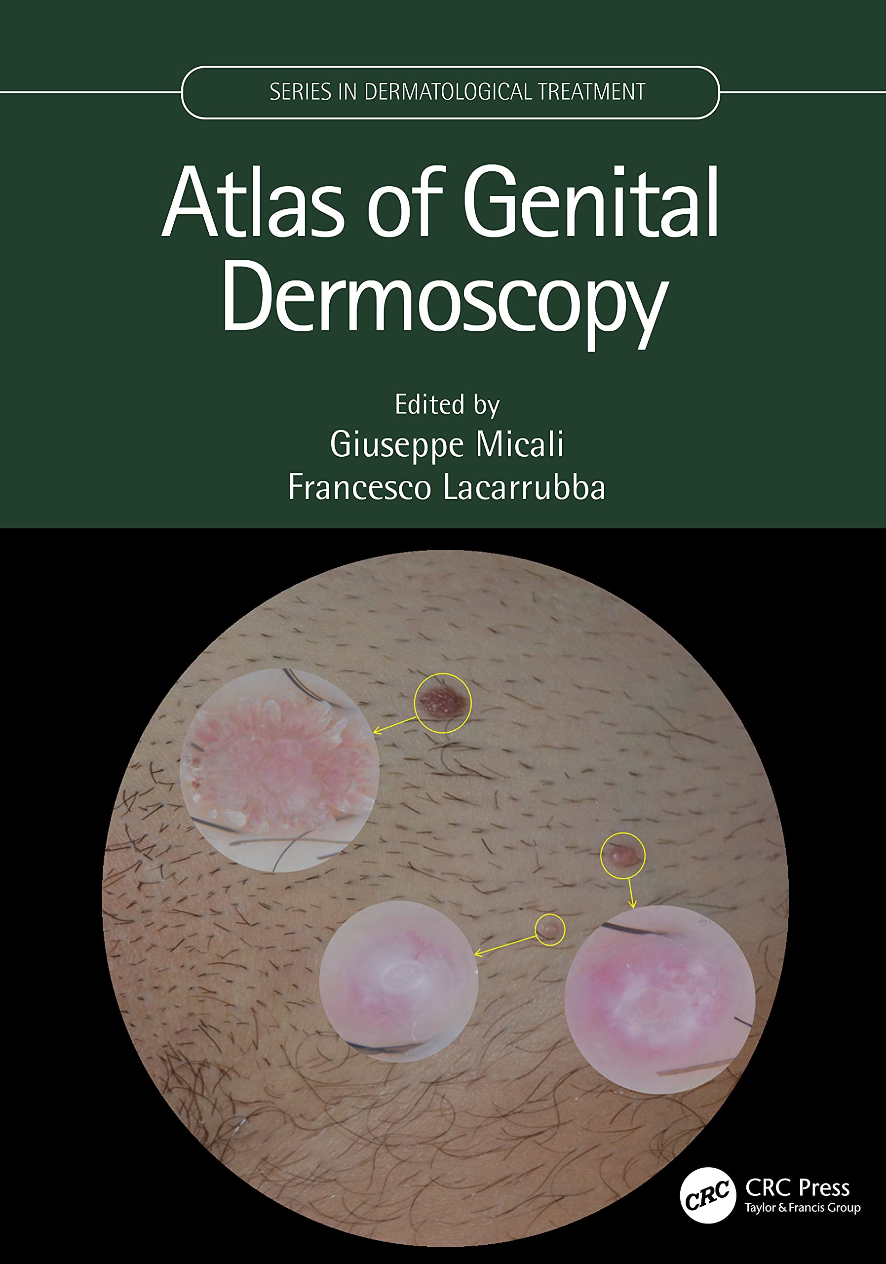 Atlas of Genital Dermoscopy (Dermatological Treatment) Medicine