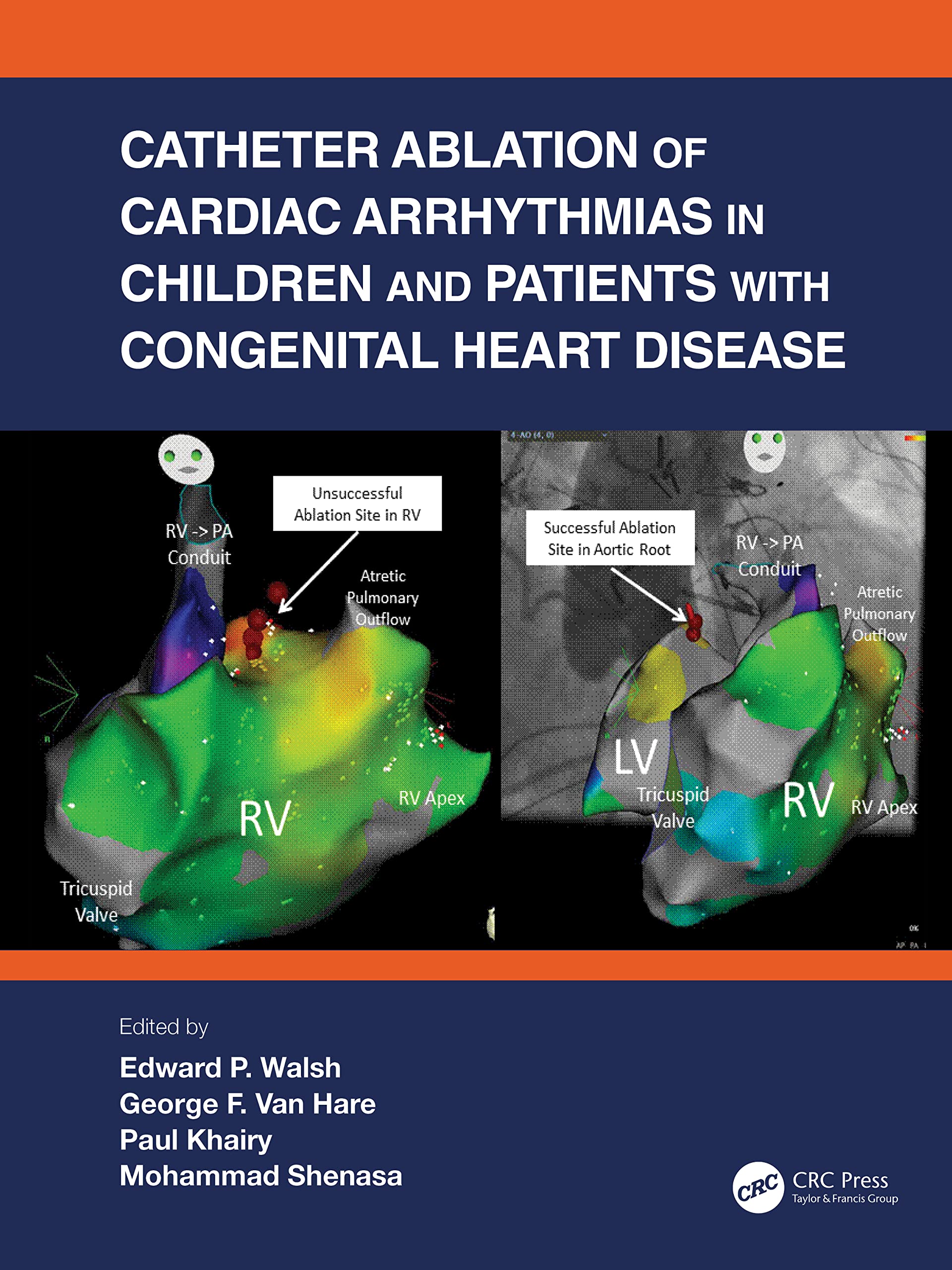 Catheter Ablation of Cardiac Arrhythmias in Children and Patients With Congenital Heart Disease Medicine