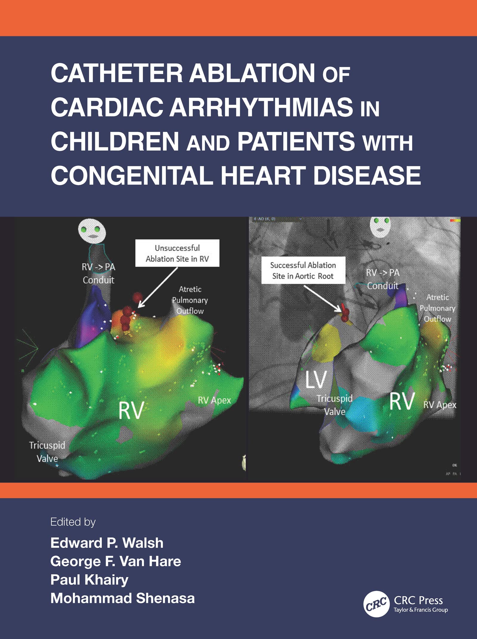 Catheter Ablation of Cardiac Arrhythmias in Children and Patients With Congenital Heart Disease Medicine