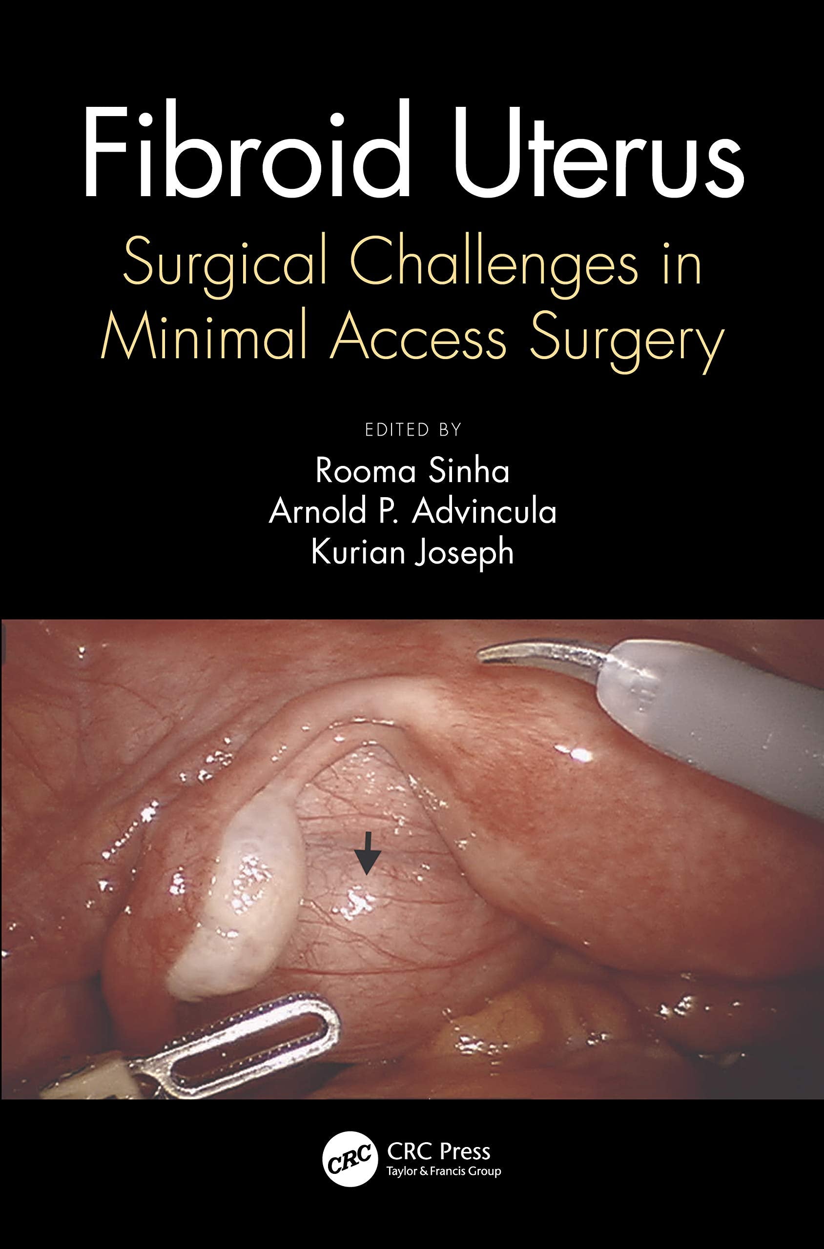 Fibroid Uterus: Surgical Challenges in Minimal Access Surgery Medicine