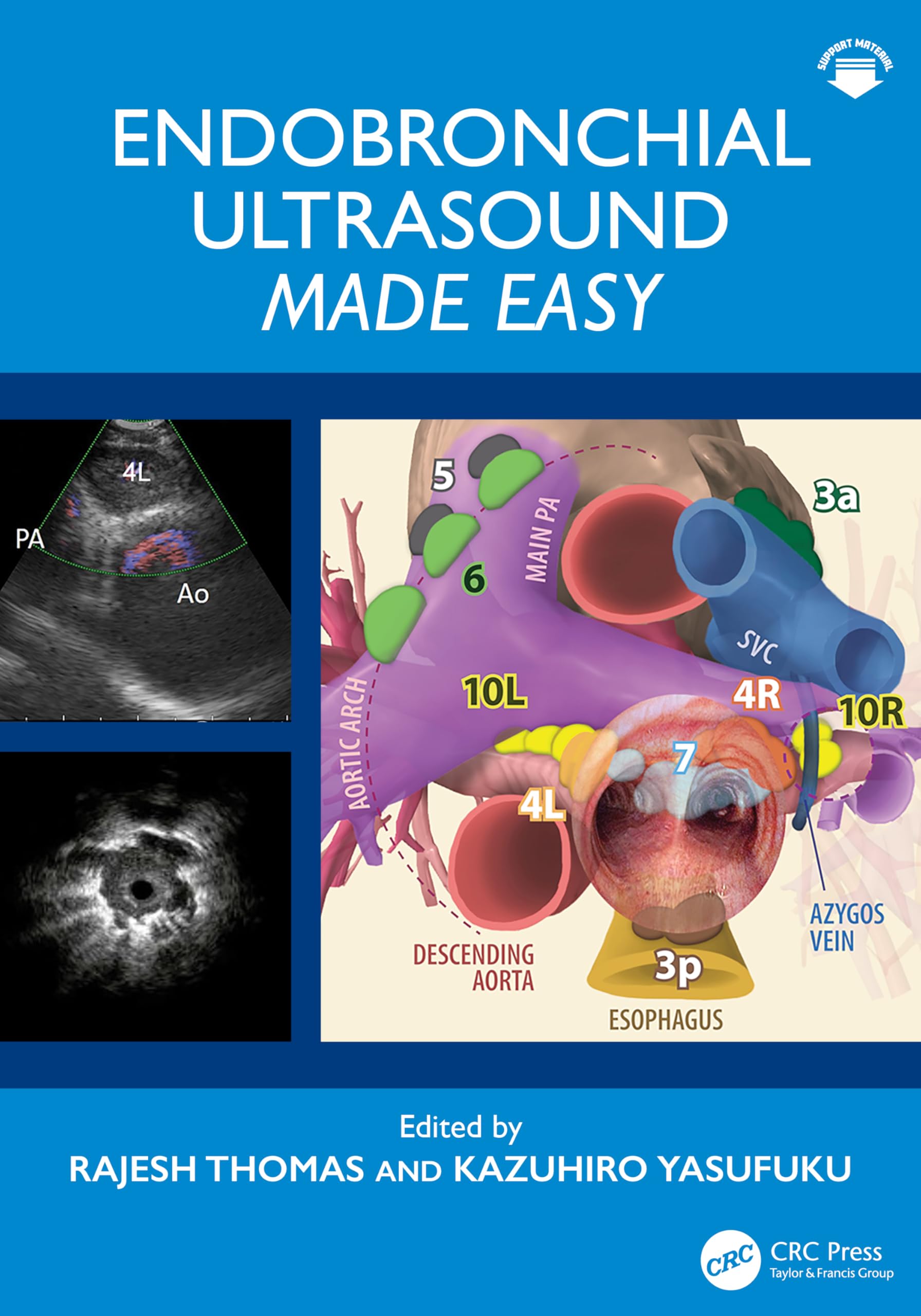 Endobronchial Ultrasound Made Easy: Made Easy Medicine
