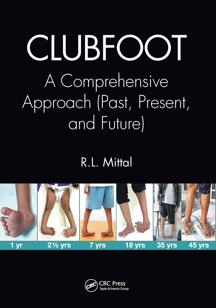 Product Image: Clubfoot