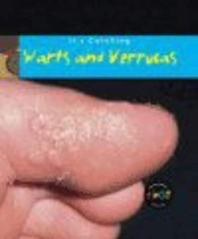 It's Catching: Warts and Verrucas Non-fiction