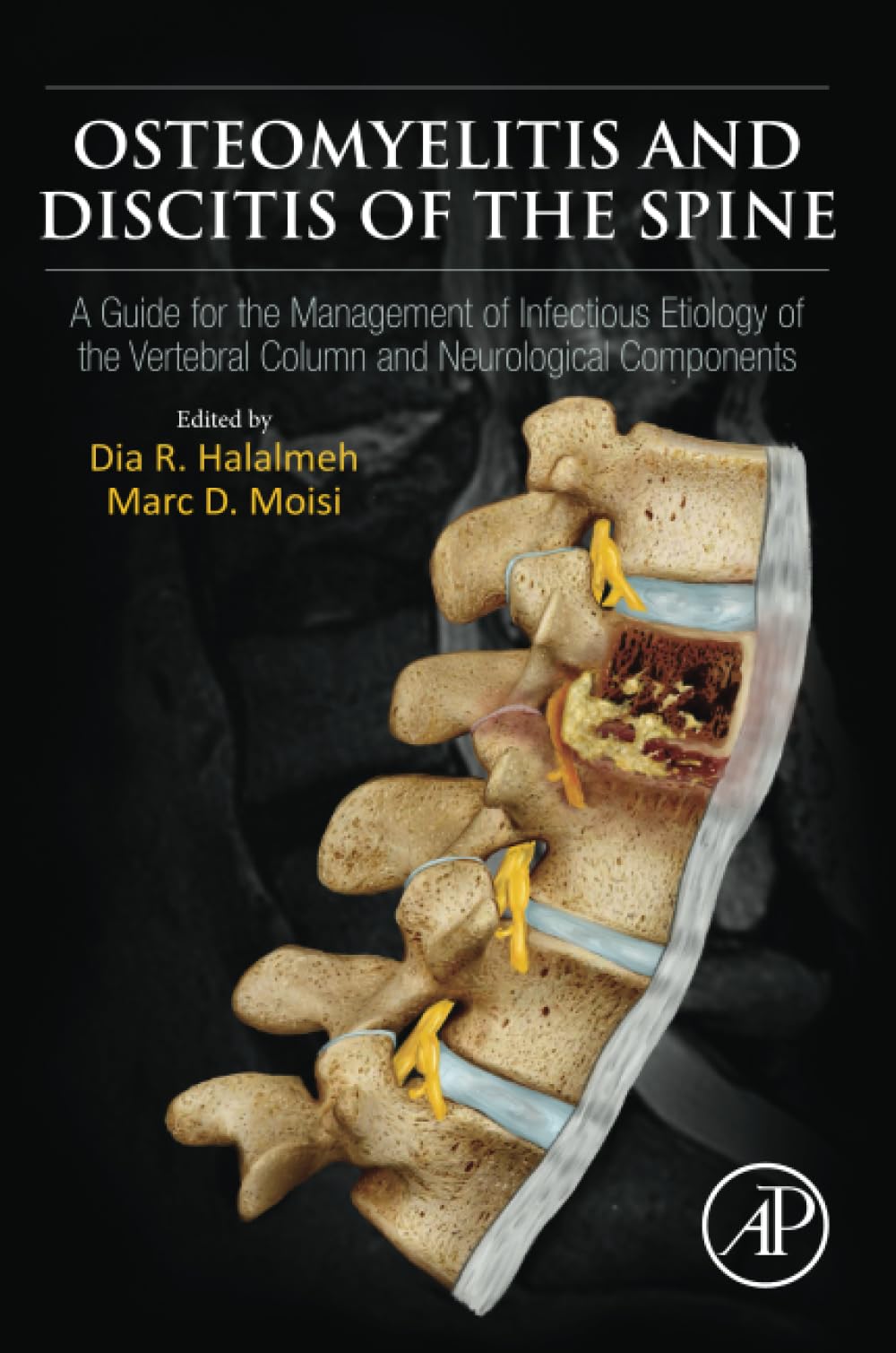 Osteomyelitis and Discitis of the Spine: A Guide for the Management of Infectious Etiology of the Vertebral Column and Neurological Components Medicine