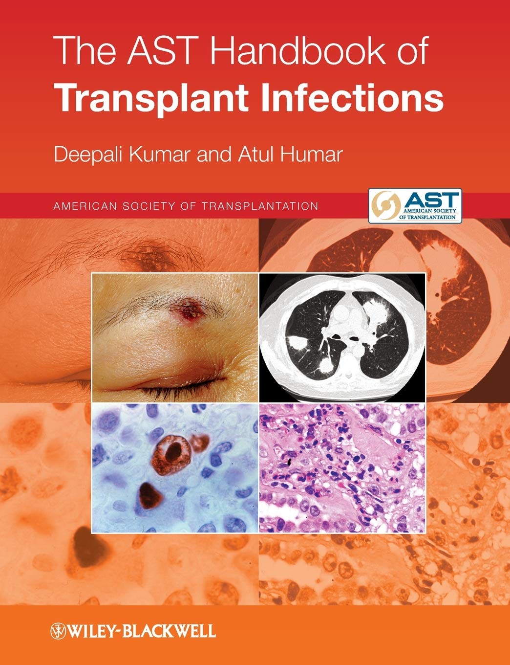 The AST Handbook of Transplant Infections Medicine