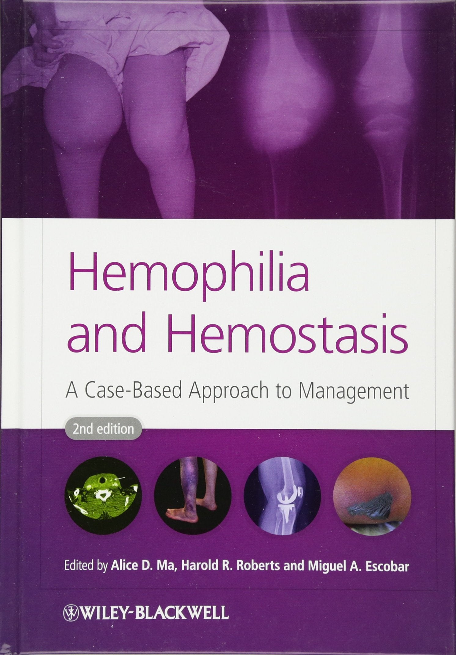 Hemophilia and Hemostasis: A Case-Based Approach to Management Medicine