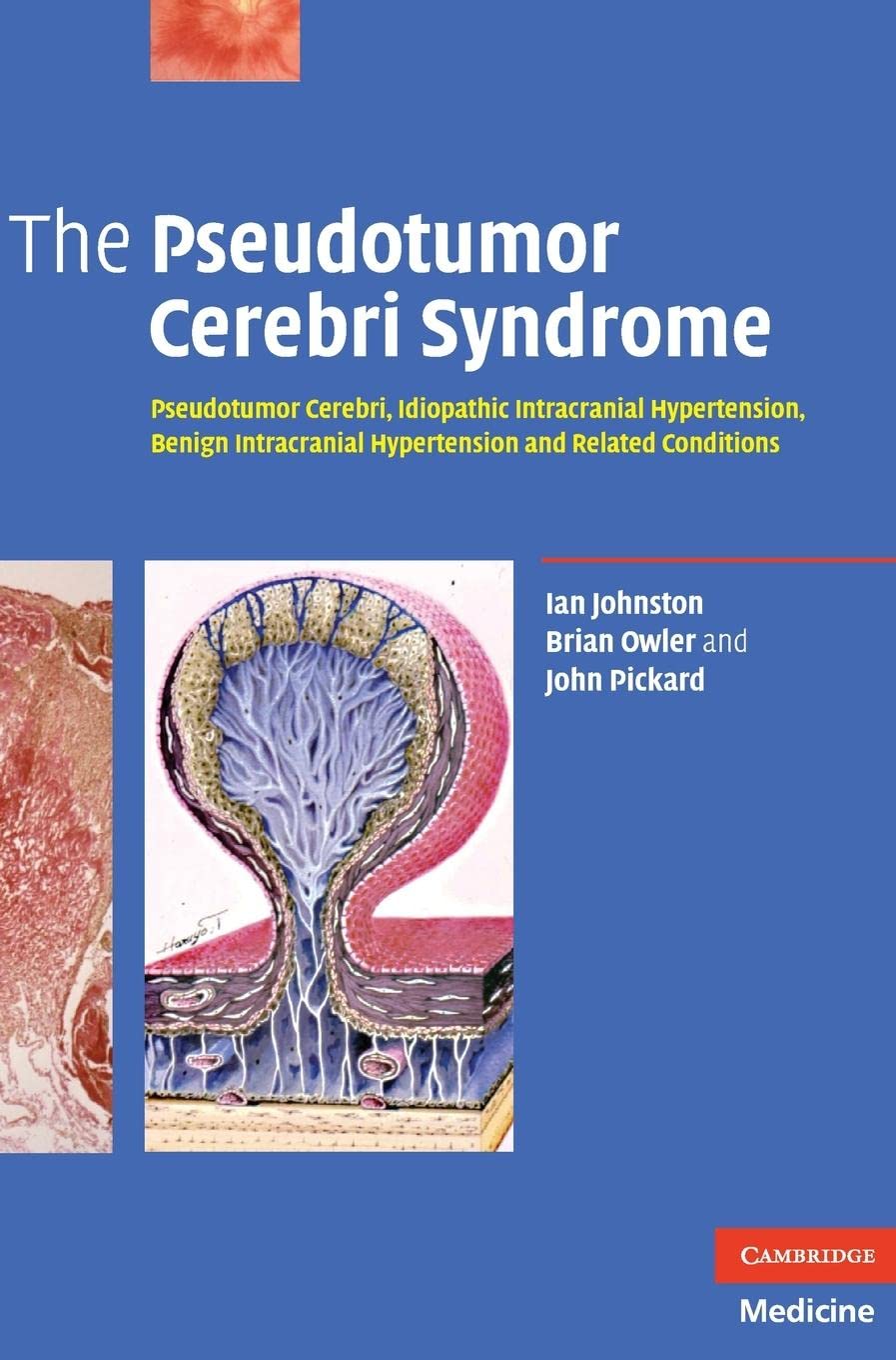 The Pseudotumor Cerebri Syndrome: Pseudotumor Cerebri, Idiopathic Intracranial Hypertension, Benign Intracranial Hypertension And Related Conditions Medicine