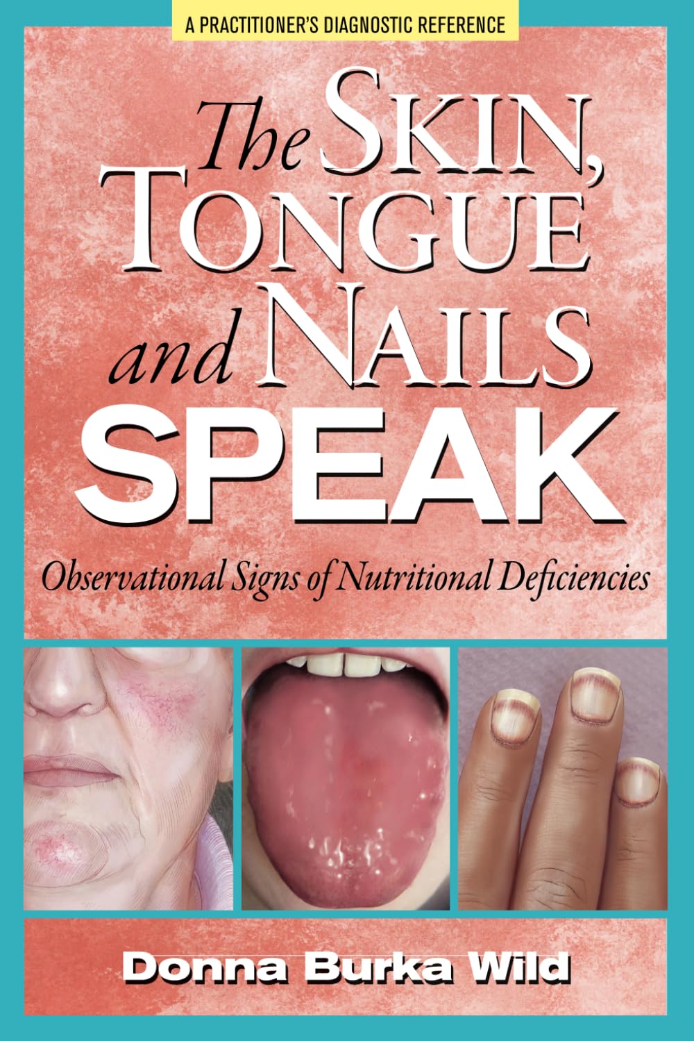 The Skin, Tongue and Nails Speak: Observational Signs of Nutritional Deficiencies book