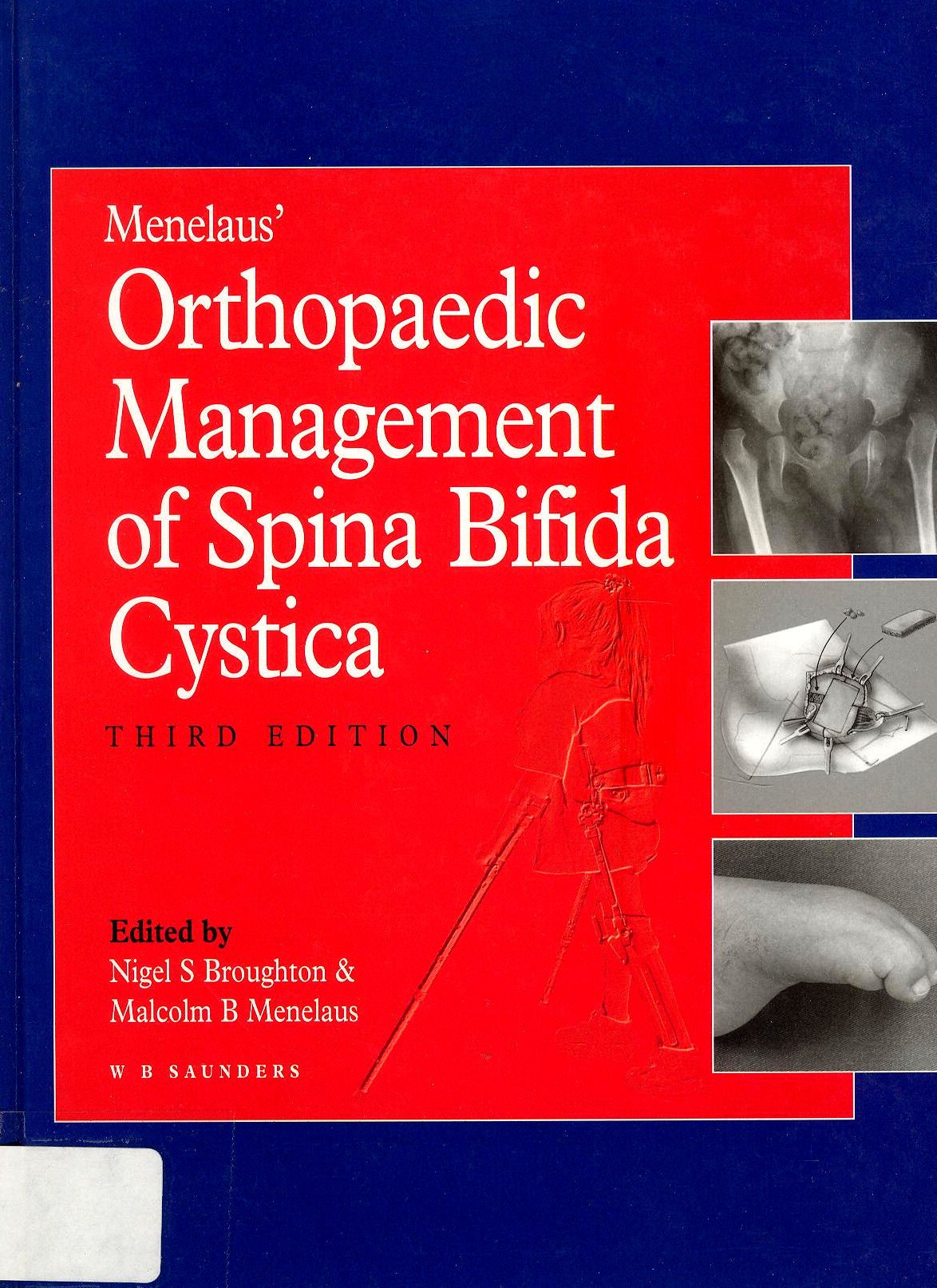 Menelaus' Orthopedic Management of Spina Bifida Cystica Medicine