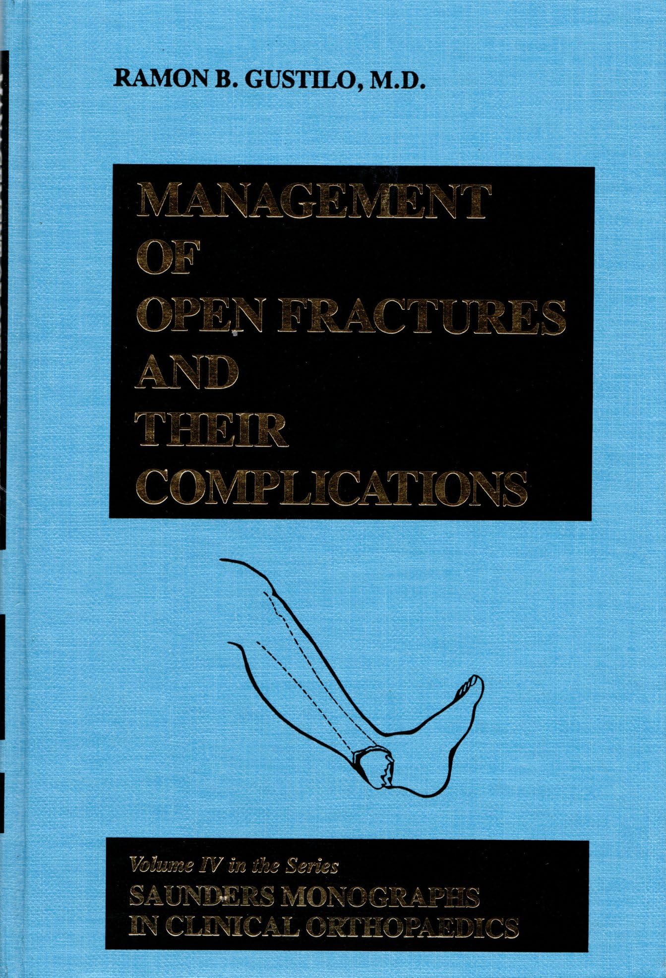 Management of Open Fractures and Their Complications Medicine