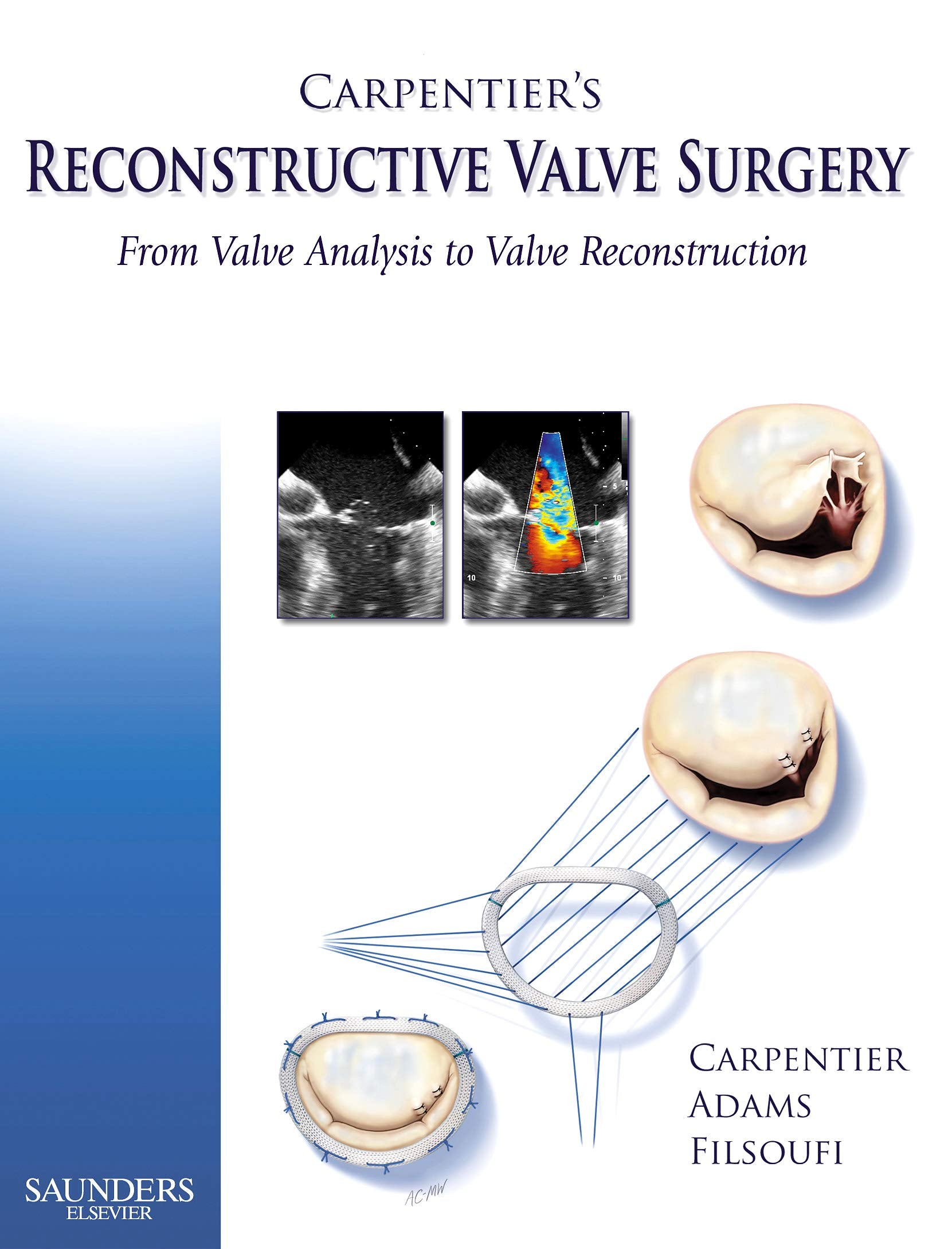 Carpentier's Reconstructive Valve Surgery: From Valve Analysis to Valve Reconstruction book