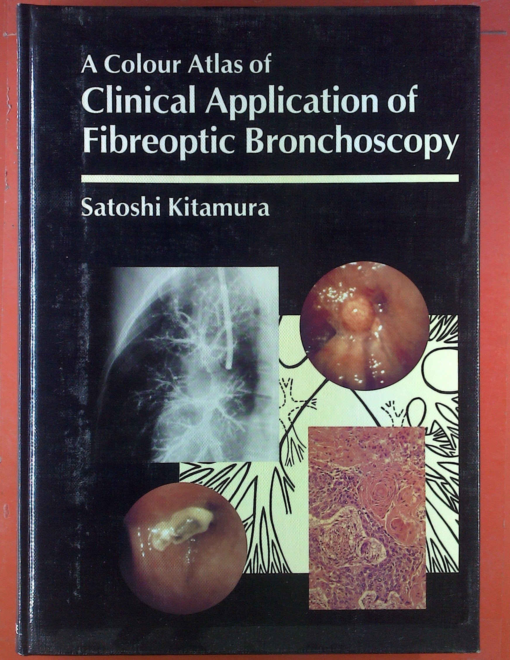 Clinical Application of Fibre Optic Bronchoscopy book