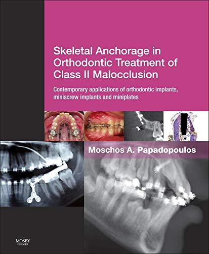 Skeletal Anchorage in Orthodontic Treatment of Class II Malocclusion: Contemporary applications of orthodontic implants, miniscrew implants and mini plates Medicine