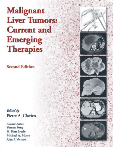 Malignant Liver Tumors: Current and Emerging Therapies Medicine