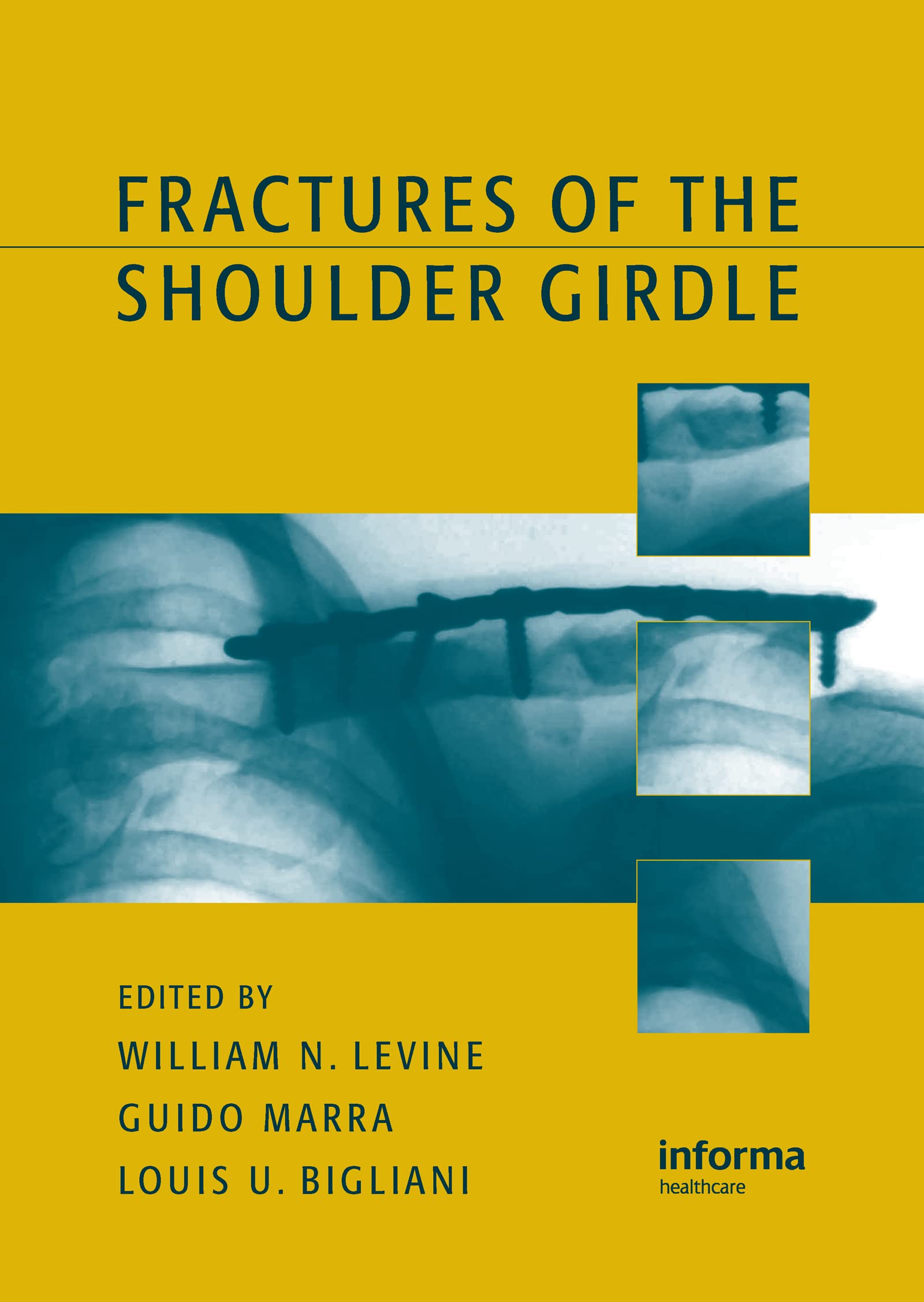 Fractures of the Shoulder Girdle Medicine