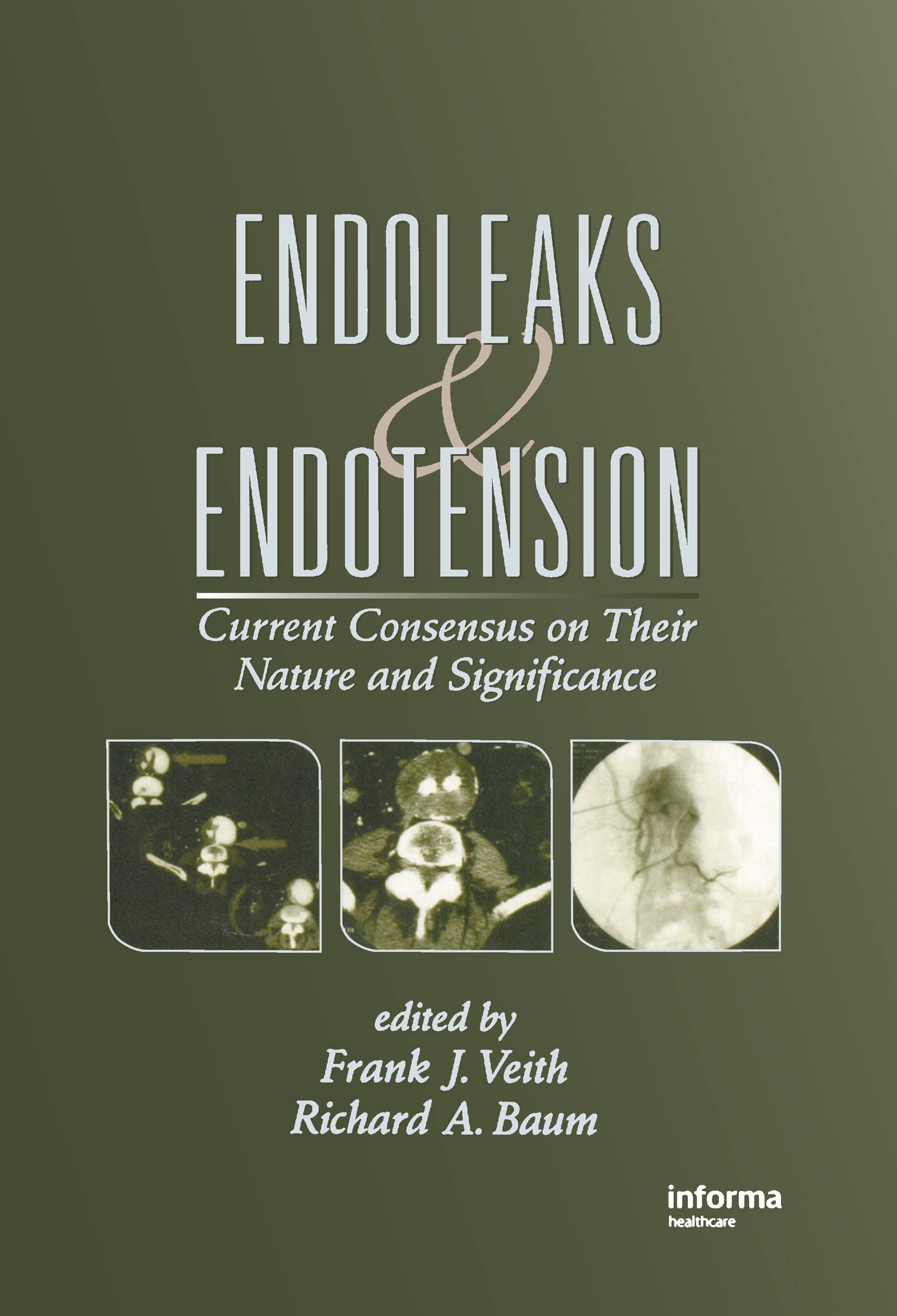 Endoleaks and Endotension: Current Consensus on Their Nature and Significance Medicine