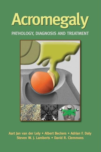 Acromegaly: Pathology, Diagnosis And Treatment Medicine