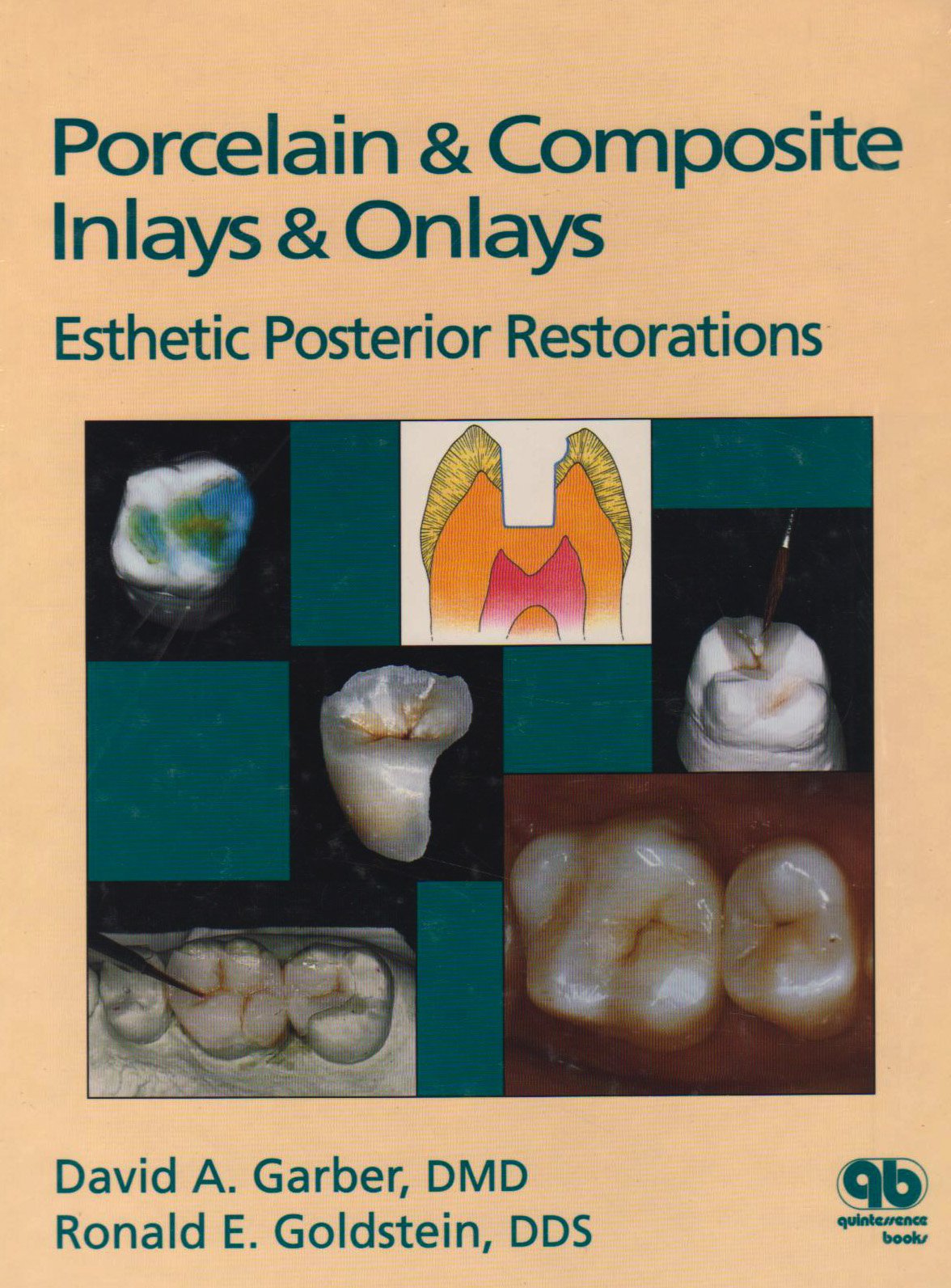 Porcelain and Composite Inlays and Onlays: Esthetic Posterior Restorations Medicine