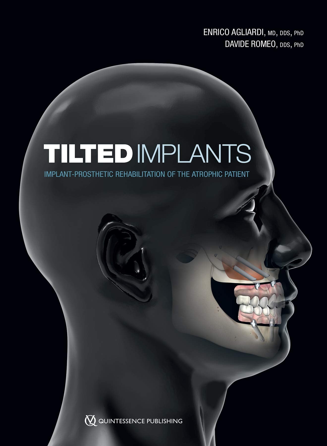 Tilted Implants: Implant-Prosthetic Rehabilitation of the Atrophic Patient: Implant-Prosethetic Rehabilitation of the Atrophic Patient Medicine