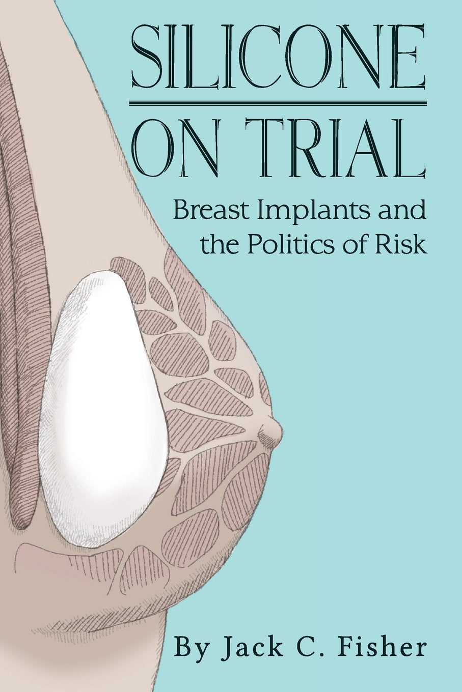Silicone On Trial: Breast Implants and the Politics of Risk Medicine