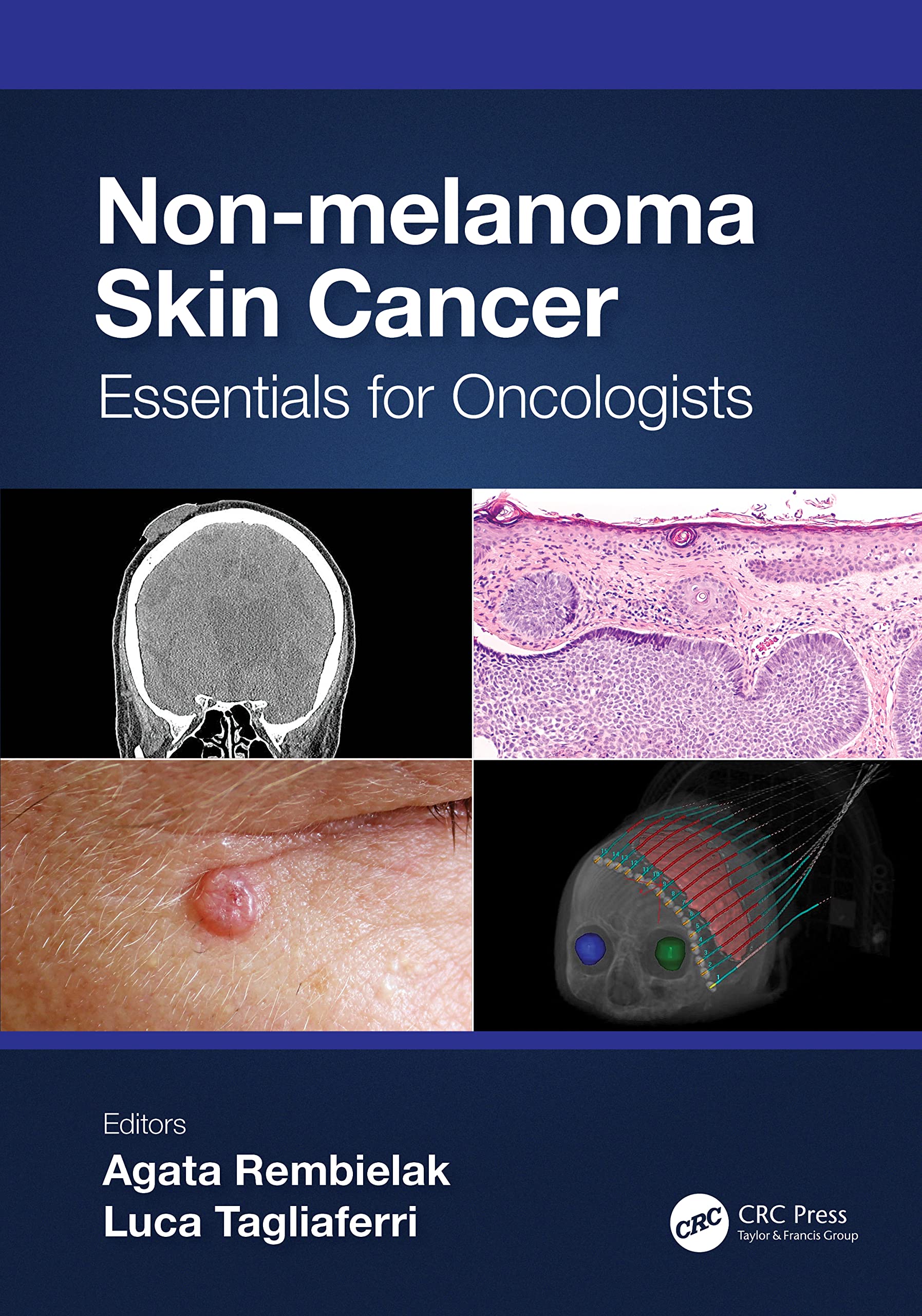 Non-Melanoma Skin Cancer: Essentials for Oncologists Medicine