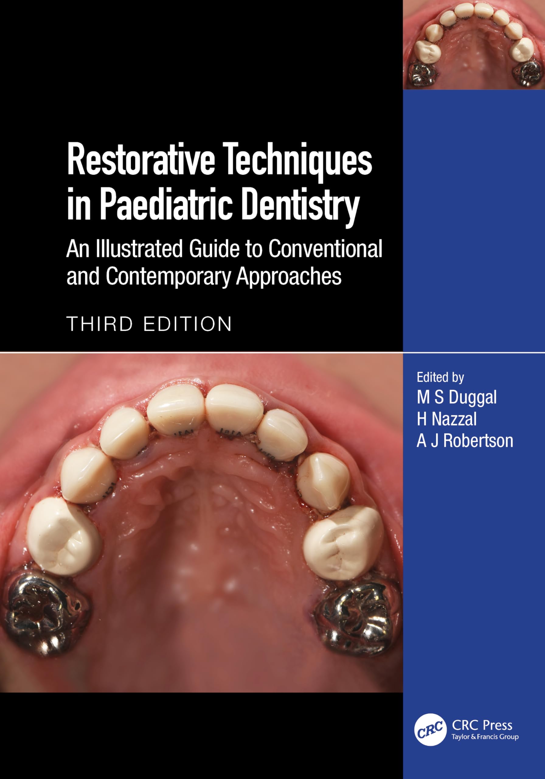 Restorative Techniques in Paediatric Dentistry: An Illustrated Guide to Conventional and Contemporary Approaches Medicine