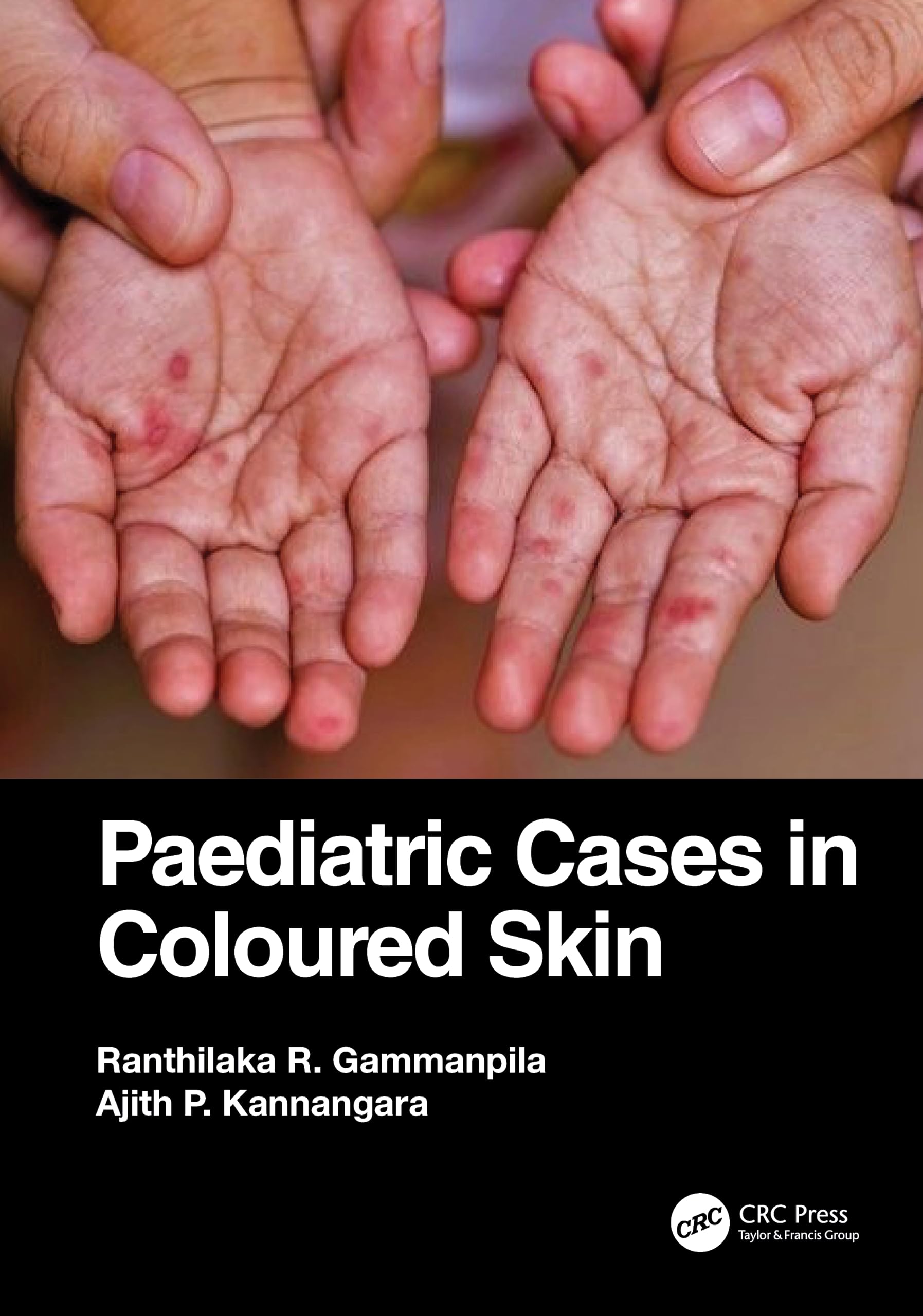 Paediatric Cases in Coloured Skin Medicine