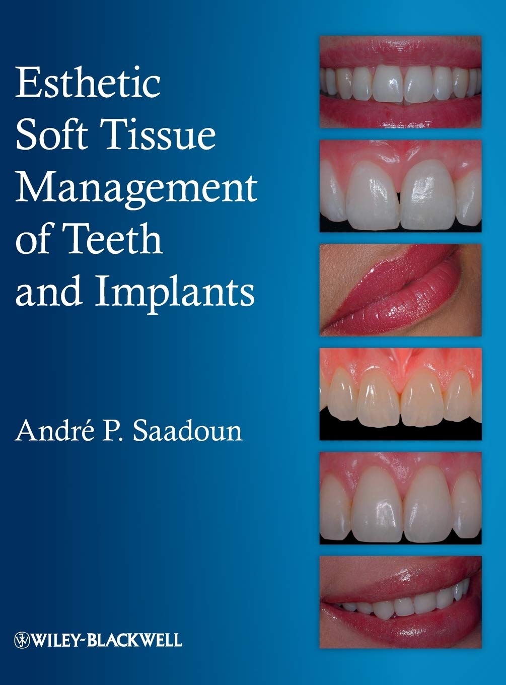 Esthetic Soft Tissue Management of Teeth and Implants Medicine