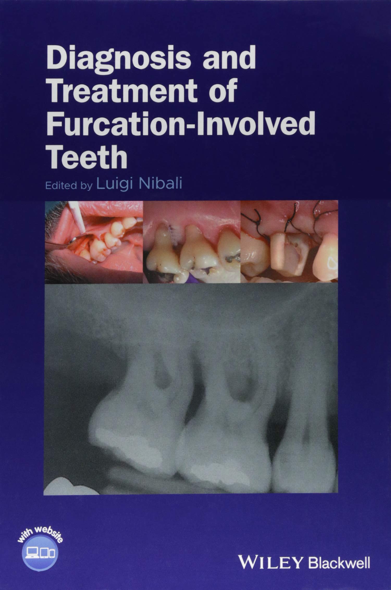 Diagnosis and Treatment of Furcation-Involved Teeth Medicine