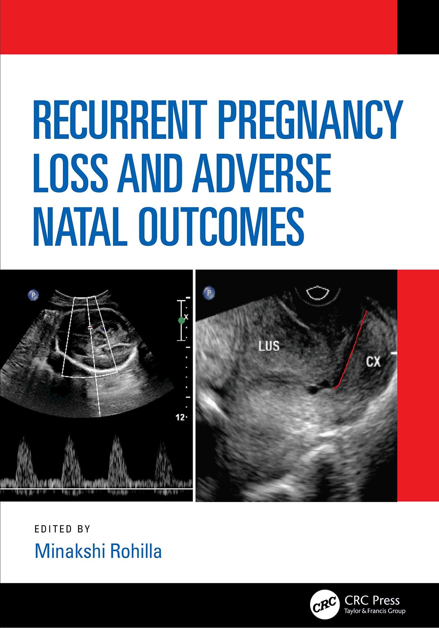 Recurrent Pregnancy Loss and Adverse Natal Outcomes Medicine