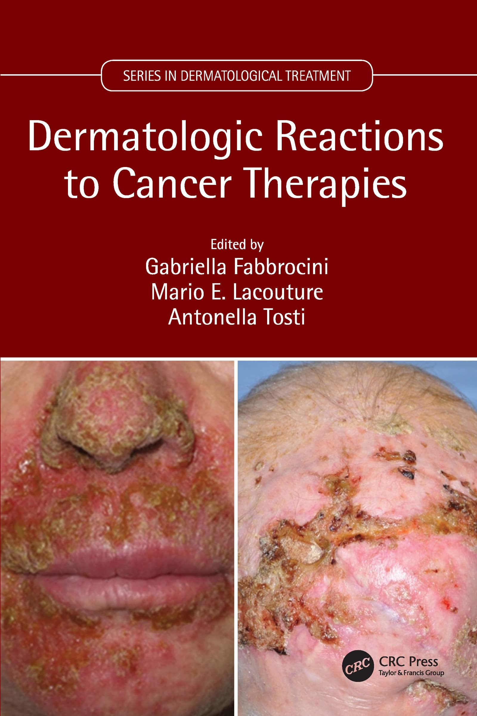 Dermatologic Reactions to Cancer Therapies (Series in Dermatological Treatment) Medicine