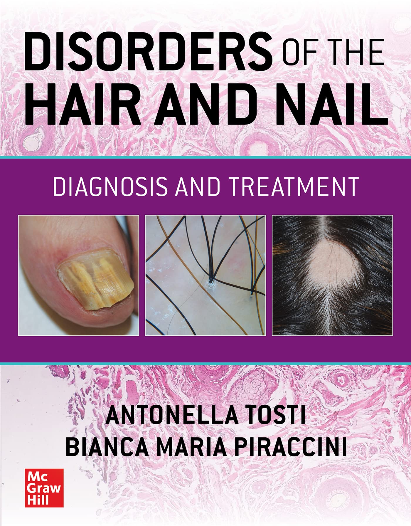 Disorders of the Hair and Nail: Diagnosis and Treatment (Medicina) Medicine