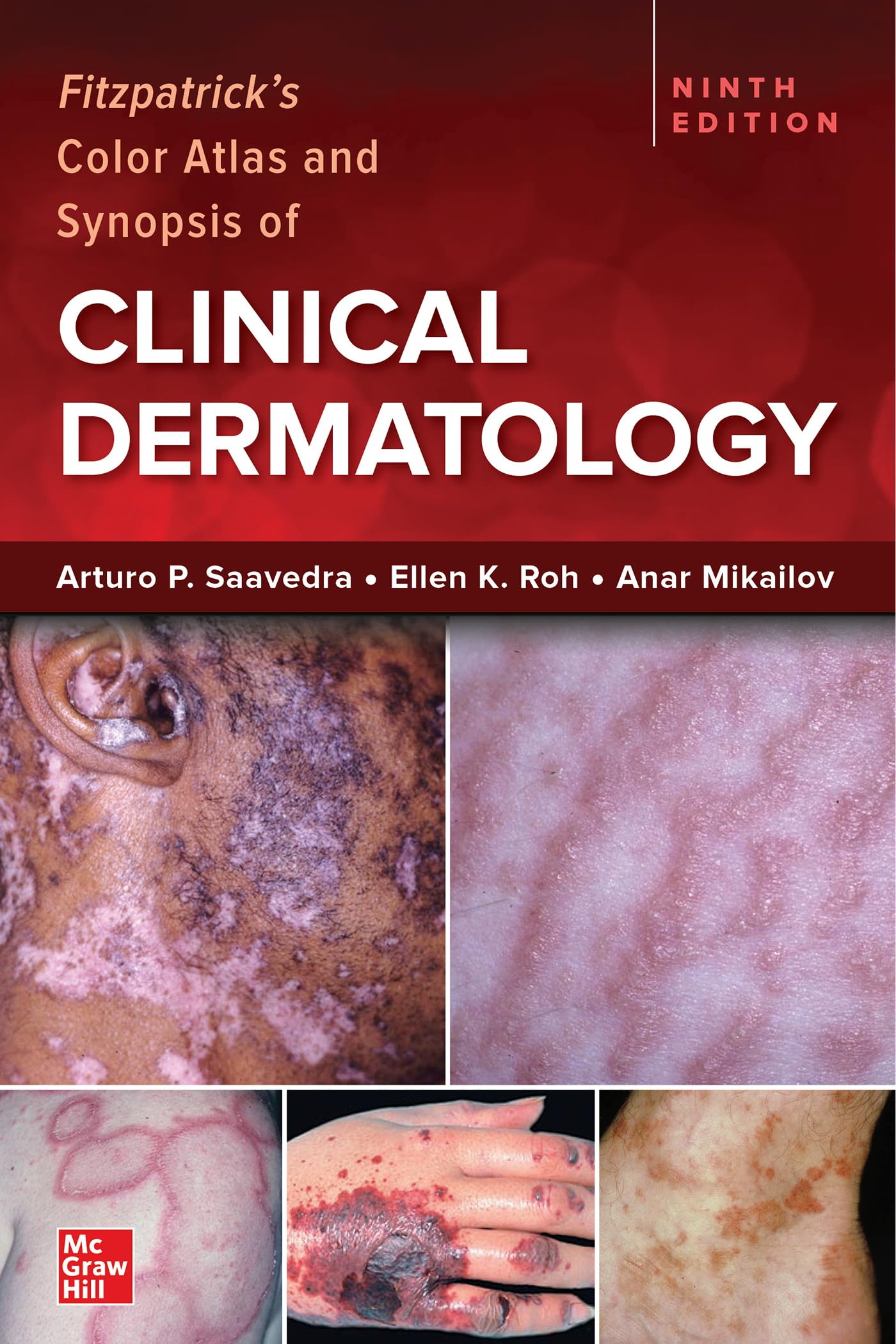 Fitzpatrick's Color Atlas and Synopsis of Clinical Dermatology, Ninth Edition (Medicina) Medicine