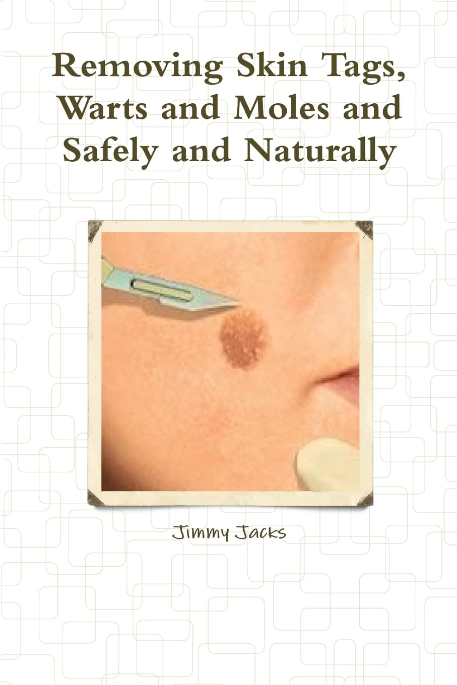 Removing Skin Tags, Warts and Moles and Safely and Naturally Business & Technology