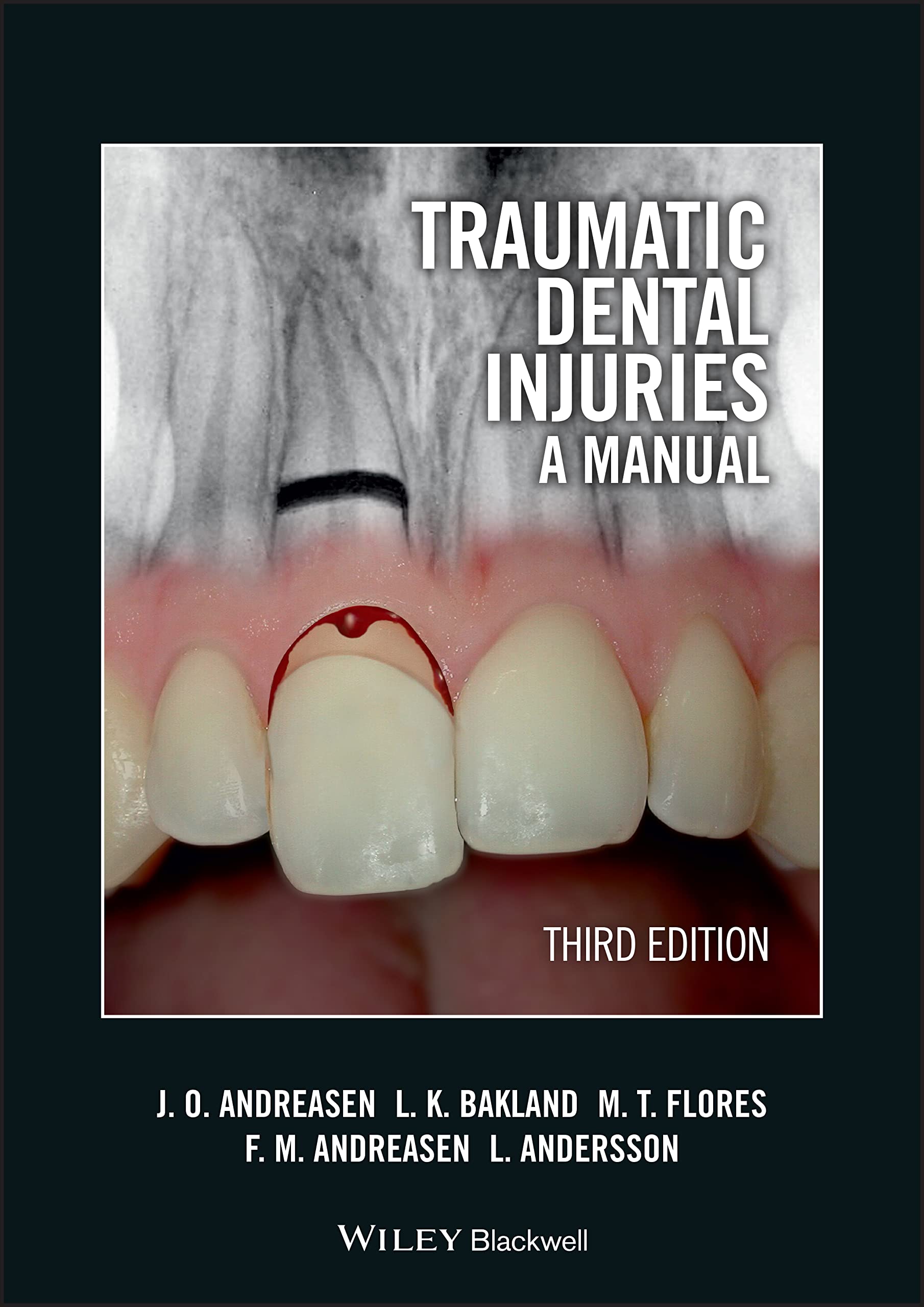 Traumatic Dental Injuries: A Manual book