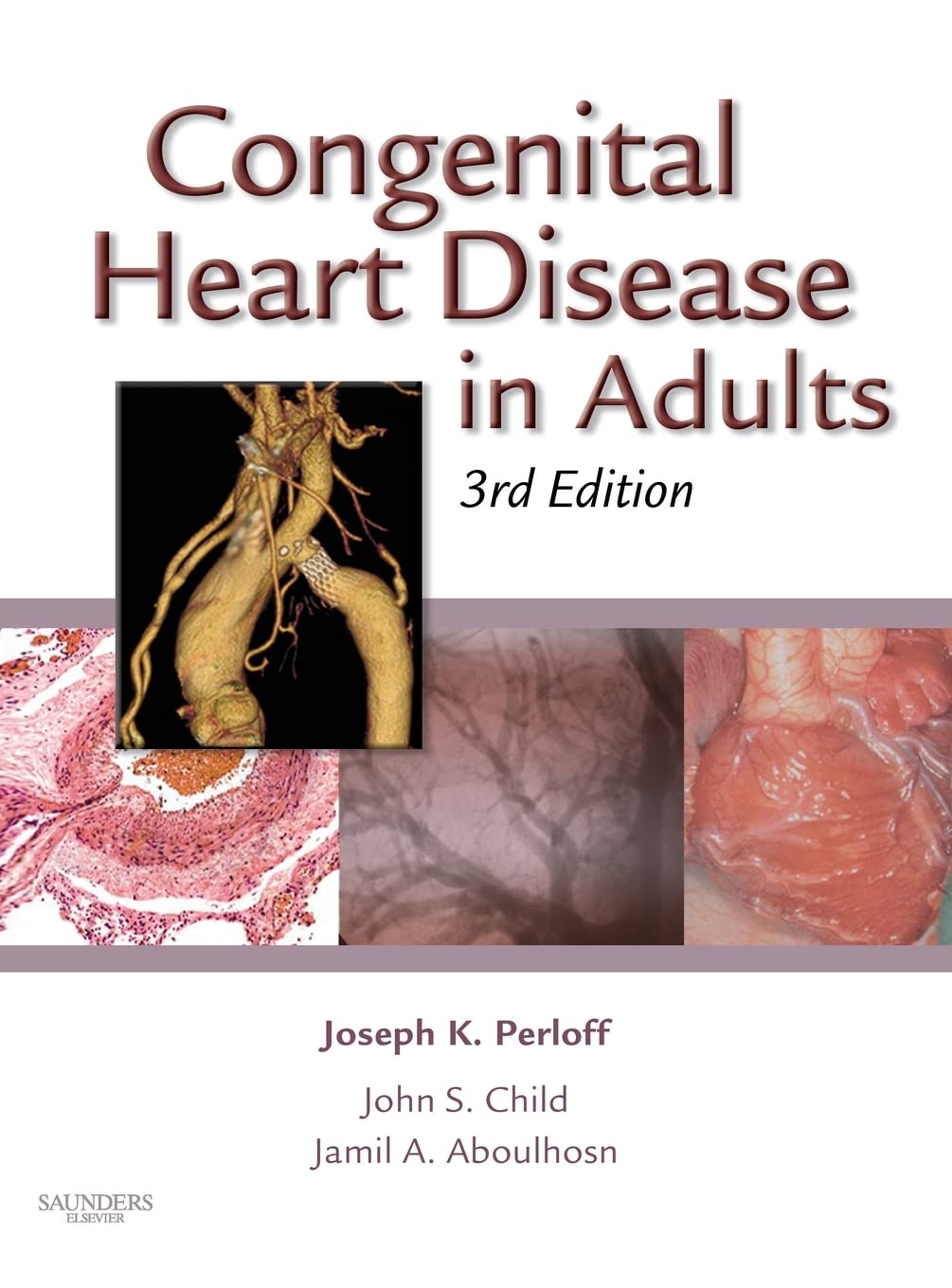 Congenital Heart Disease in Adults Medicine