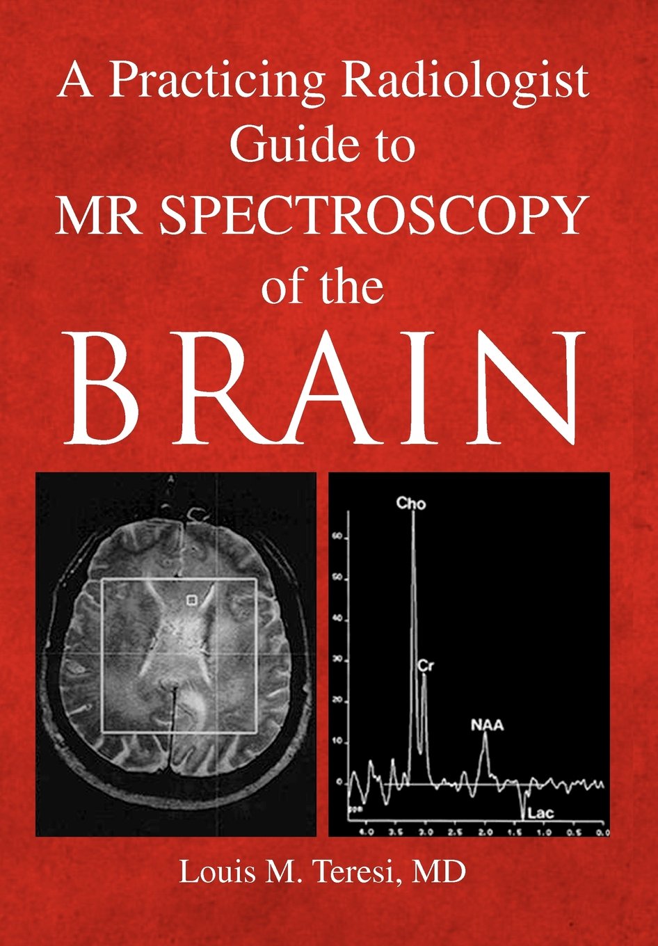 A Practicing Radiologist Guide to MR Spectroscopy of the Brain Medicine