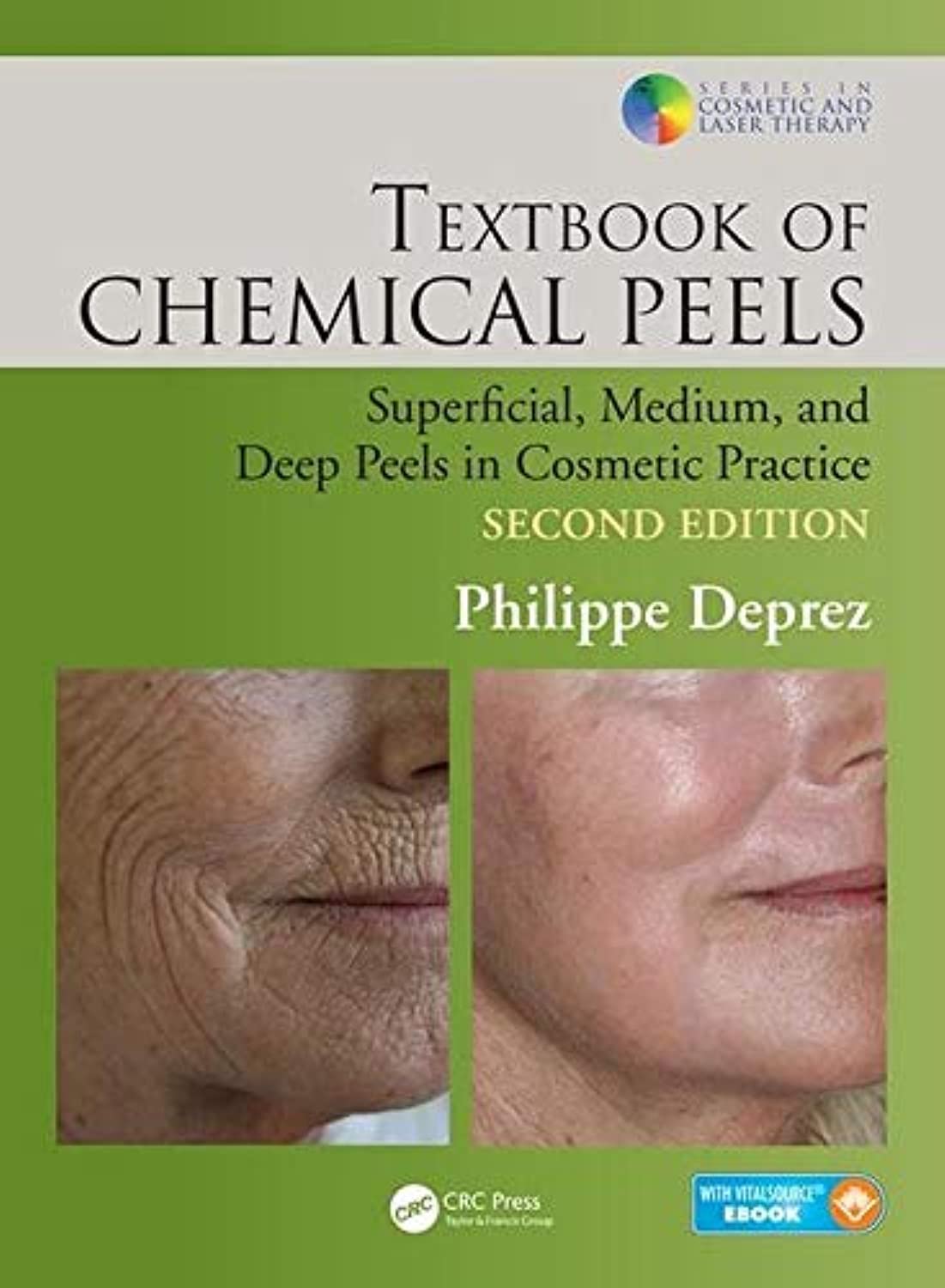 Textbook of Chemical Peels Medicine