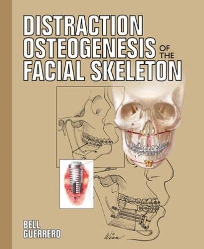 Distraction Osteogenesis of the Facial Skeleton Medicine