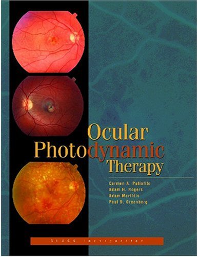 Product Image: Ocular Photodynamic Therapy