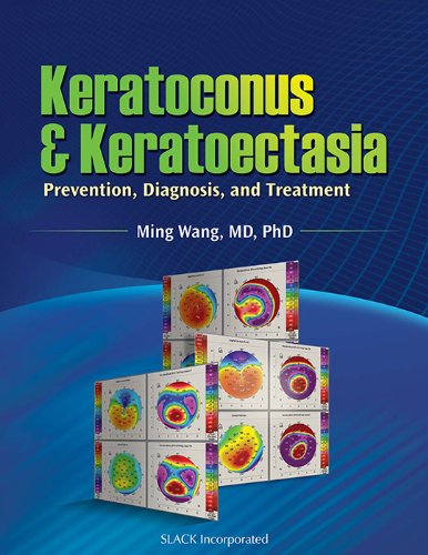 Keratoconus and Keratoectasia: Prevention, Diagnosis, and Treatment Medicine