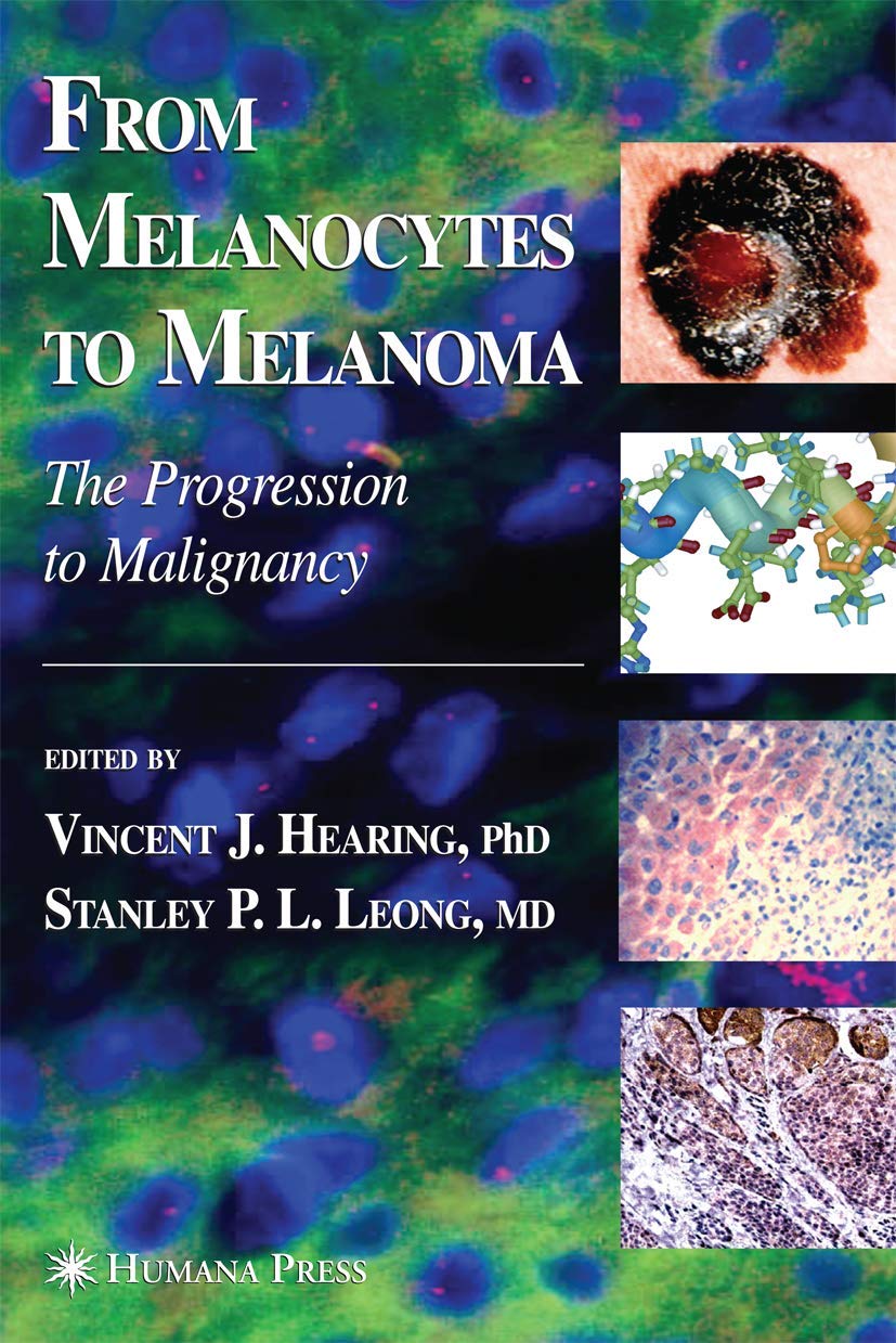 From Melanocytes to Melanoma: The Progression to Malignancy Medicine