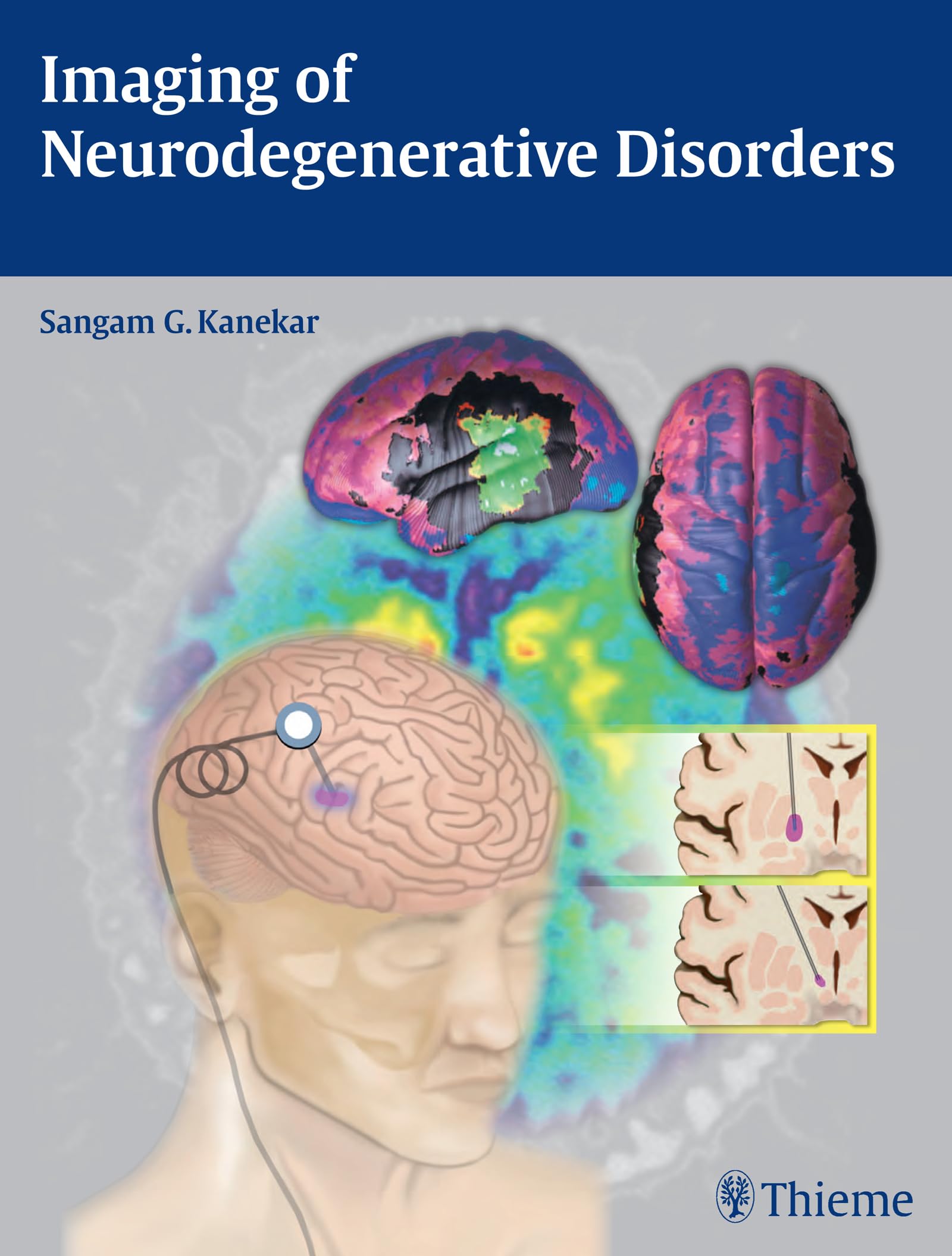 Imaging of Neurodegenerative Disorders book