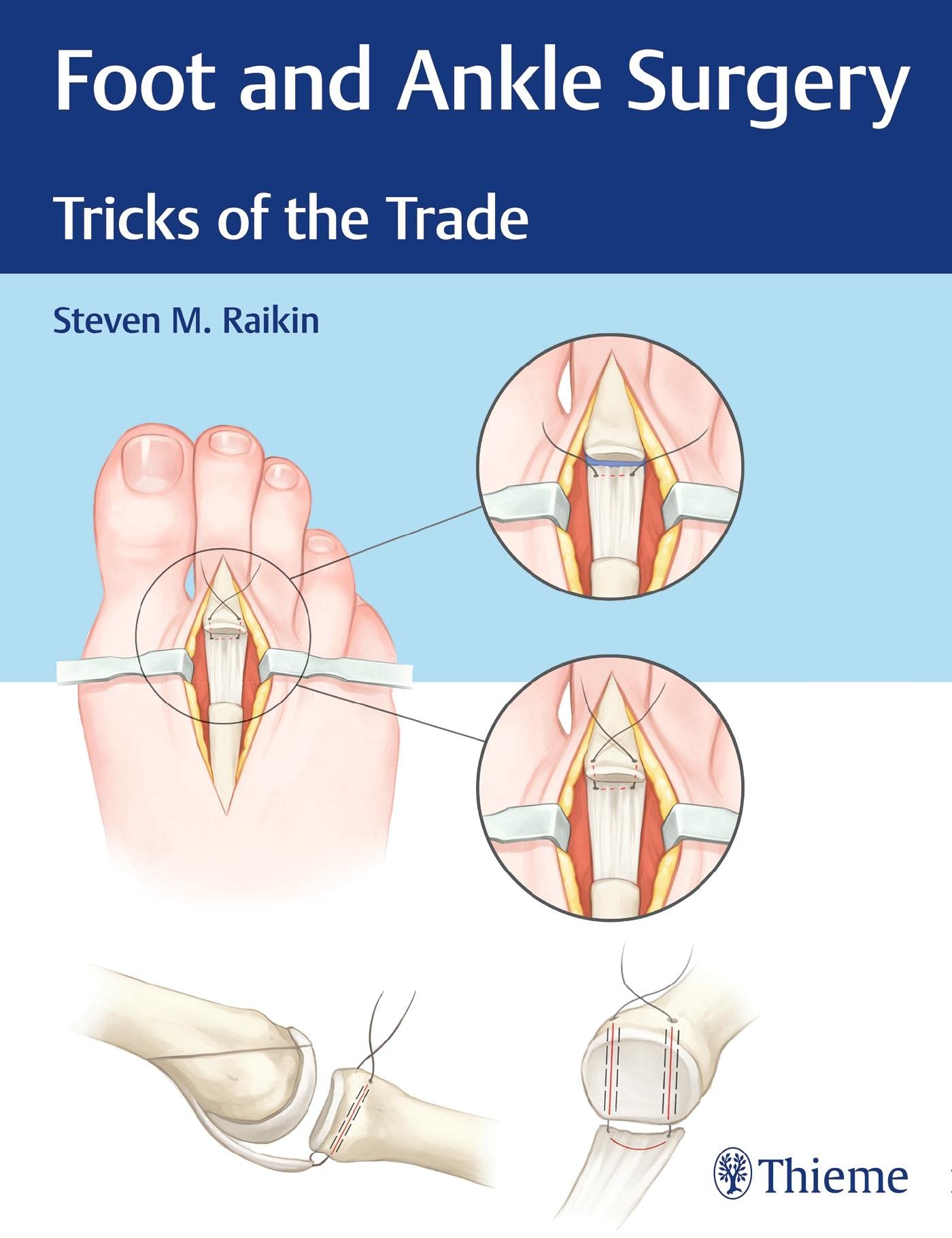 Foot and Ankle Surgery: Tricks of the Trade Medicine