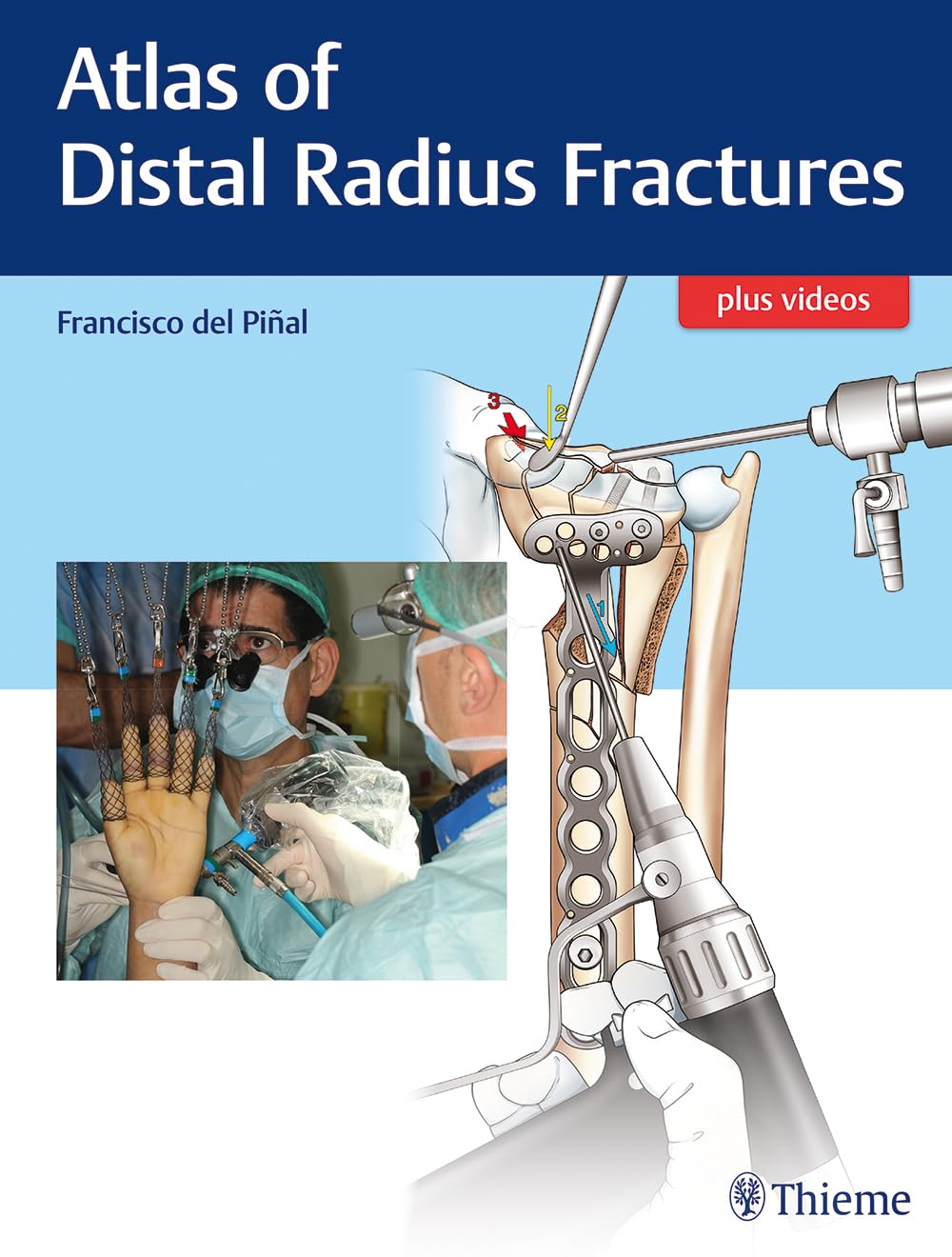 Atlas of Distal Radius Fractures Medicine